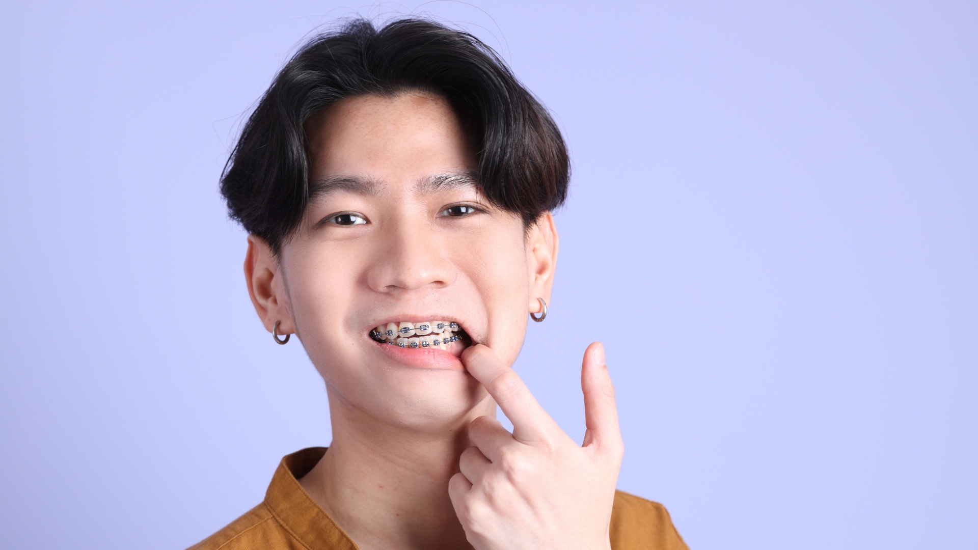 Khớp cắn ngược loại 3: Nhận diện và giải pháp điều trị hiệu quả 5
