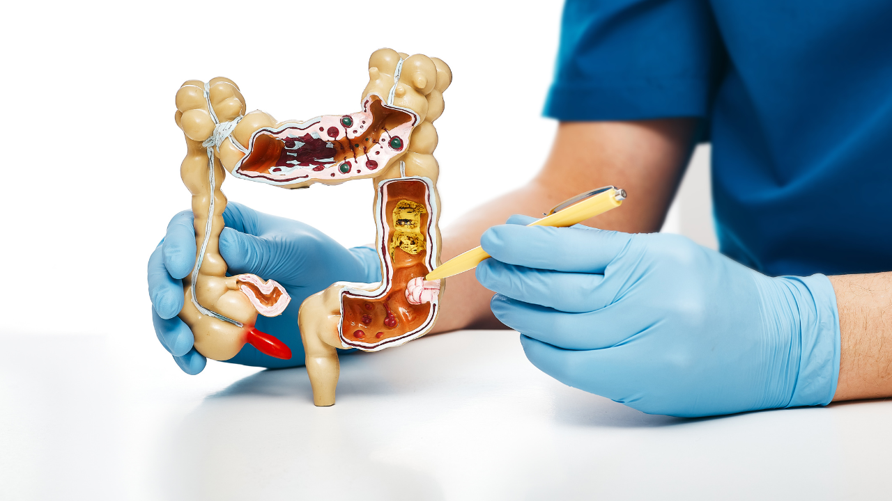 Người có nguy cơ cao mắc ung thư đại tràng cần đặc biệt chú ý đến việc tầm soát định kỳ