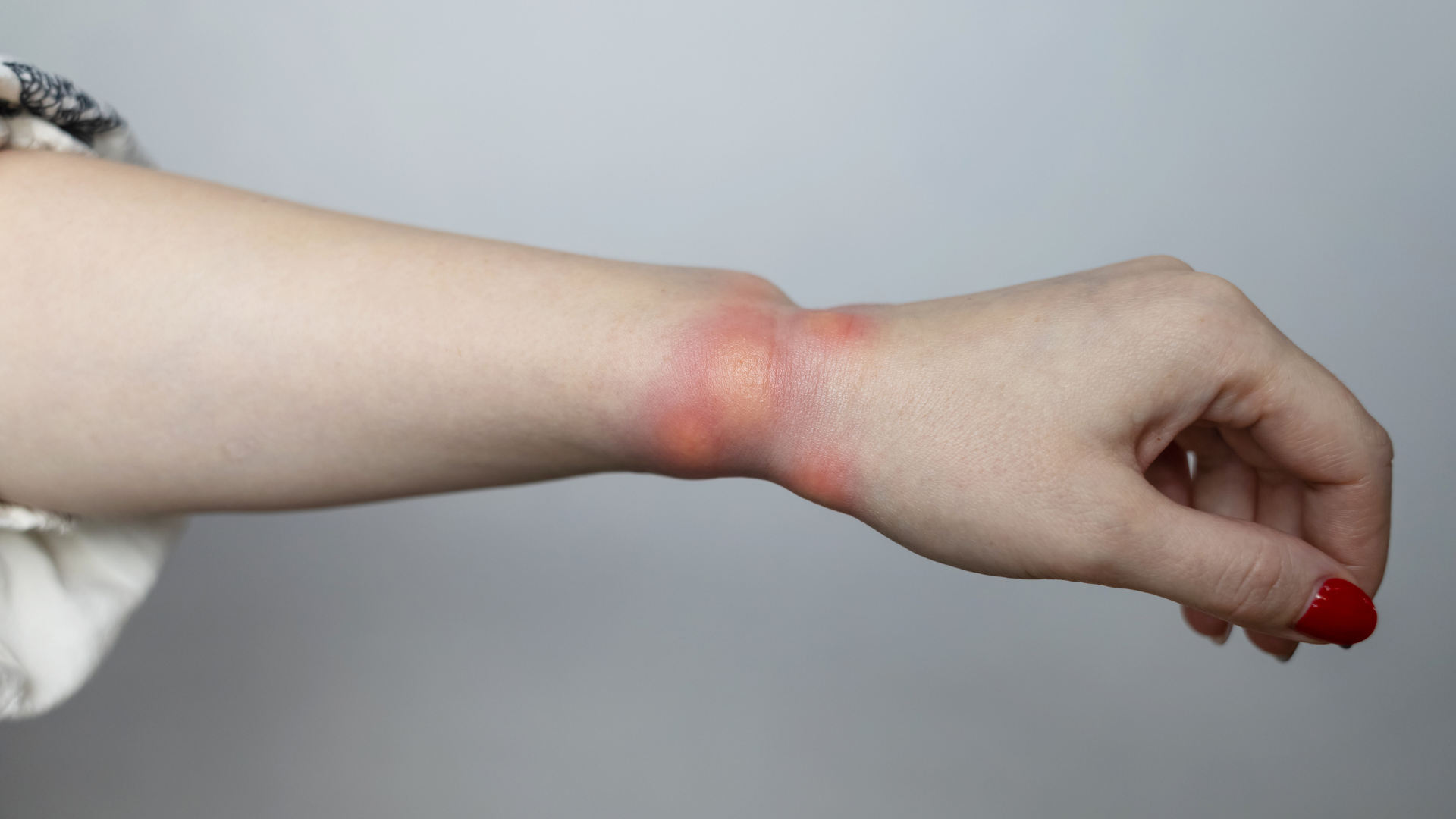 Nhận biết sớm giúp bạn xử lý kiến cắn sưng to đúng cách