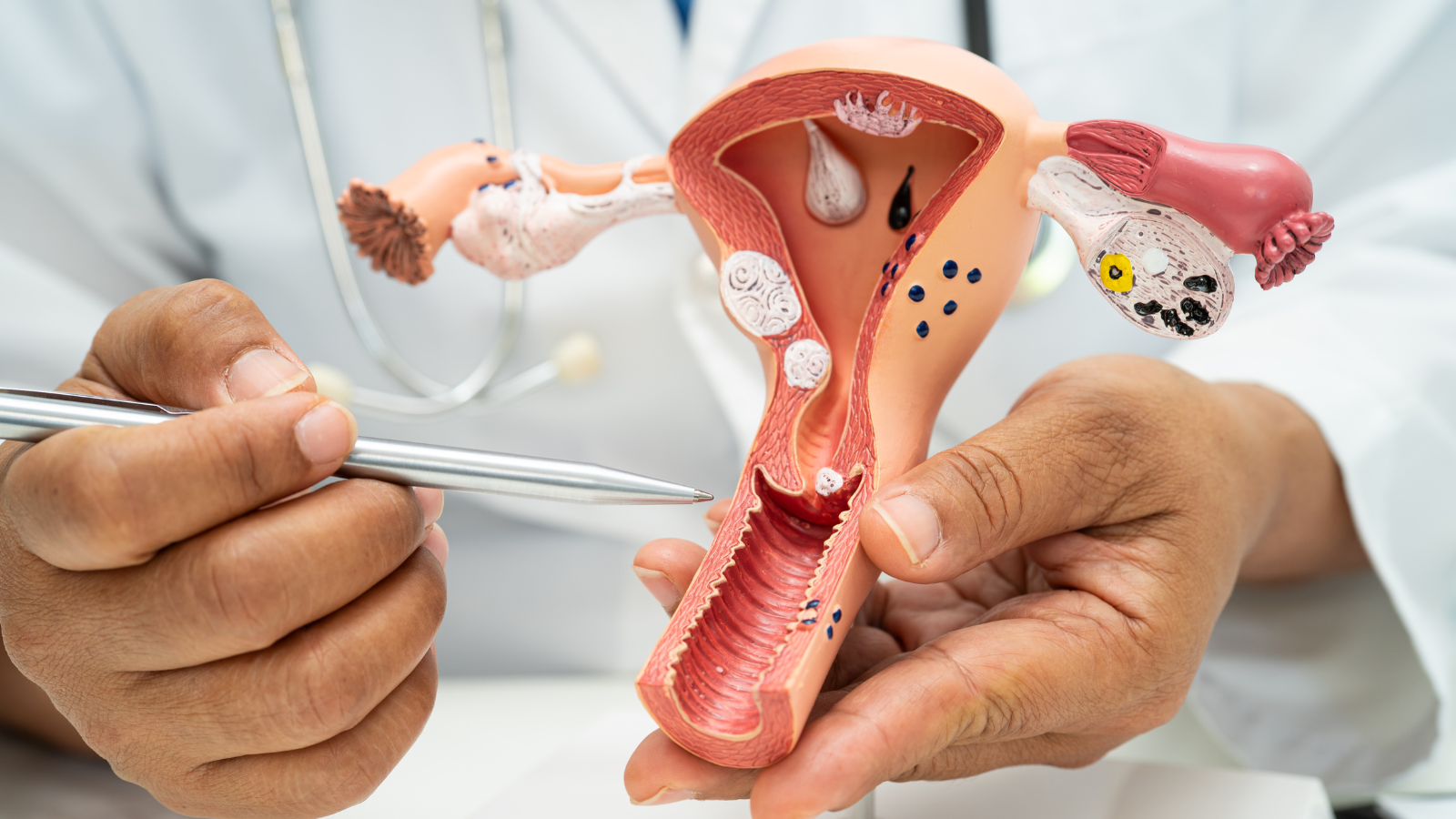 Các tổn thương lành tính tại tử cung