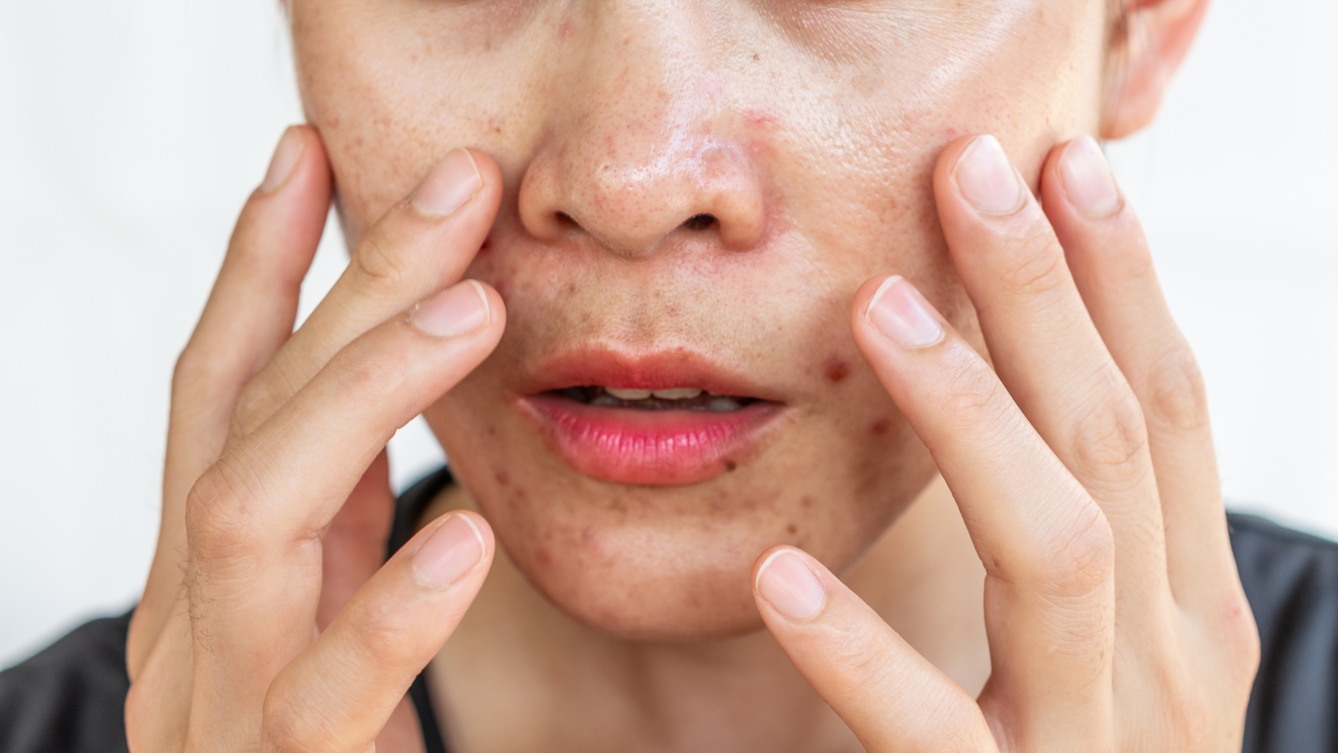 Các bệnh như viêm da tiết bã, trứng cá đỏ, viêm da quanh miệng... thường ghi nhận tỷ lệ Demodex cao hơn