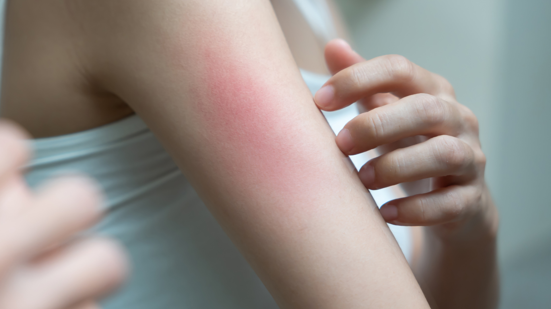 nhiễm ký sinh trùng có thể gây ngứa dữ dội