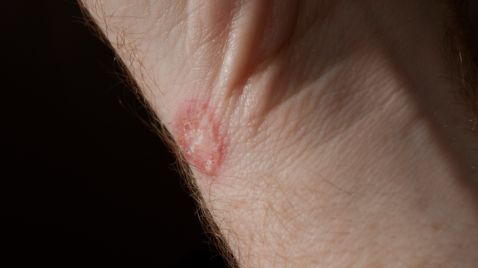 Lác đồng tiền là một bệnh nhiễm trùng ngoài da