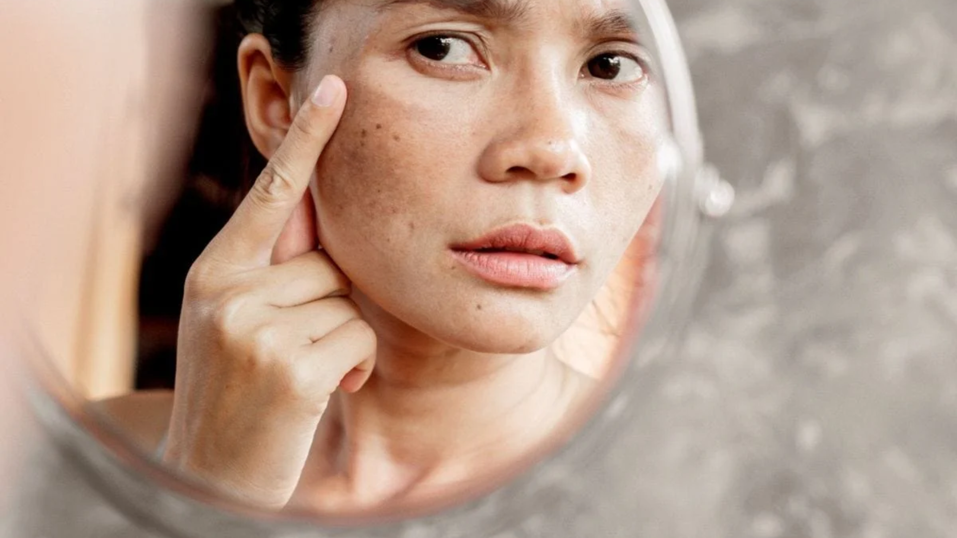 Khi sạm nám đốm nâu và sắc tố không đều xuất hiện trước tuổi 35 đó là dấu hiệu cảnh báo lão hóa da sớm