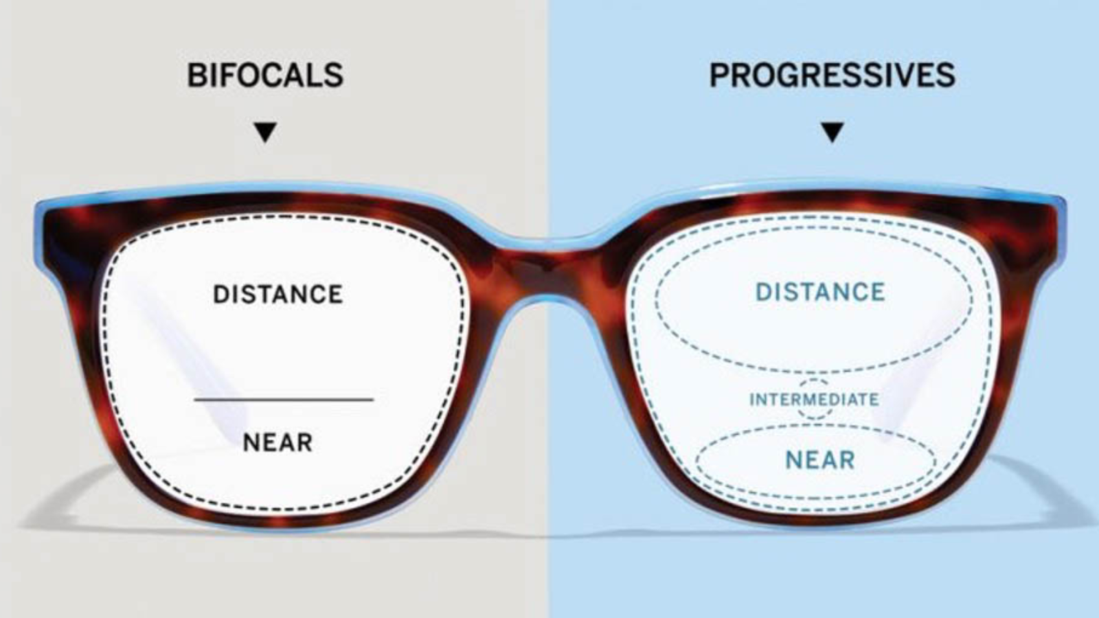 Người vừa bị lão thị vừa bị cận thị, viễn thị hoặc loạn thị nên ưu tiên kính hai tròng hoặc đa tròng
