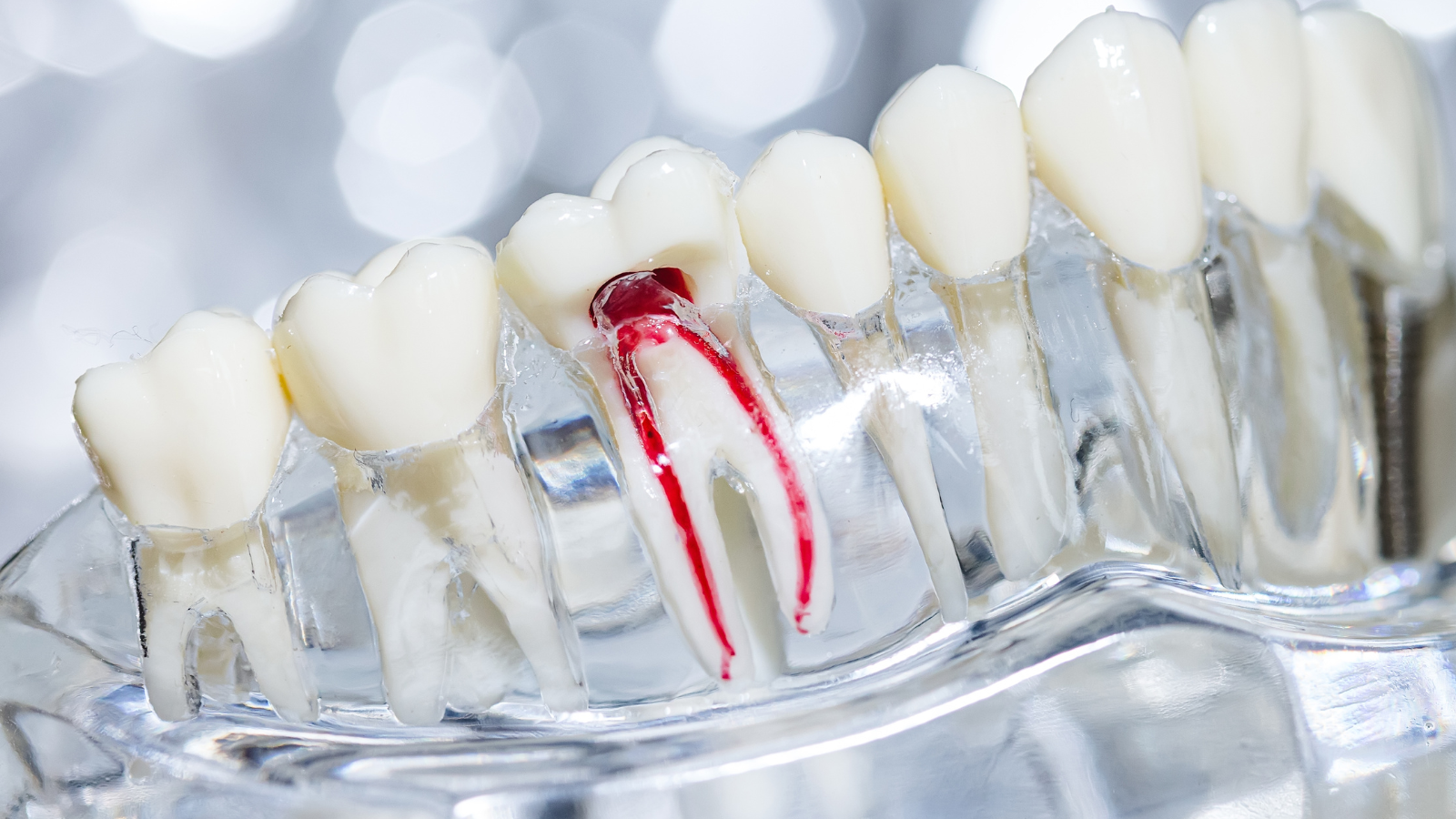 Tủy răng chết hoàn toàn, vi khuẩn lan rộng ra xung quanh làm tiêu xương