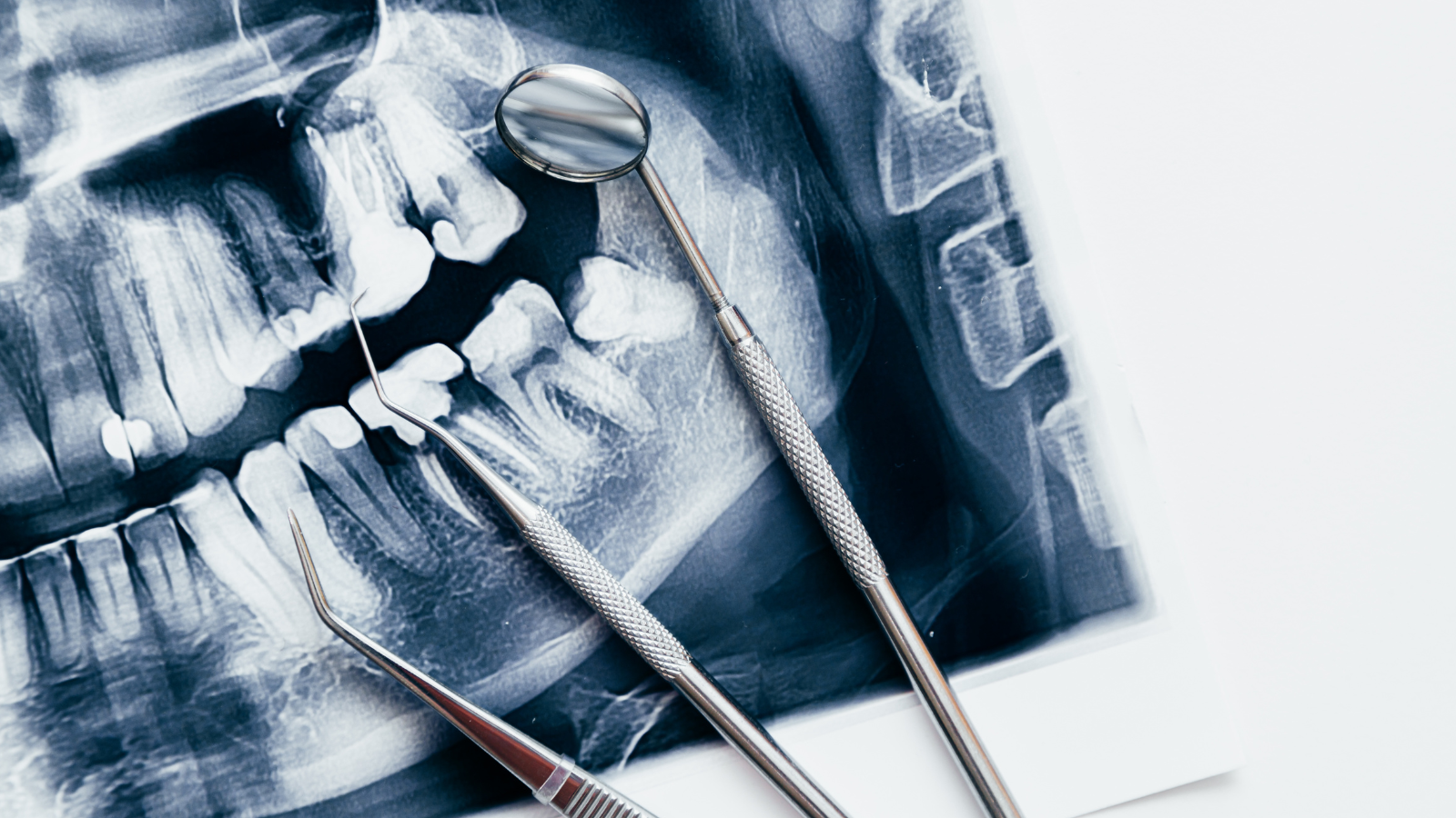 Lấy tủy răng số 7 là một quy trình phức tạp