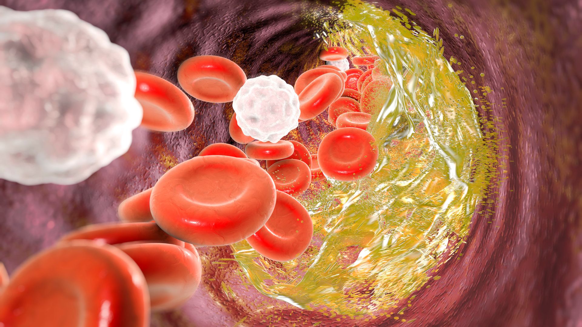 LDL cholesterol tăng cao là dấu chỉ của nguy cơ hình thành mảng sơ vữa trong mạch máu