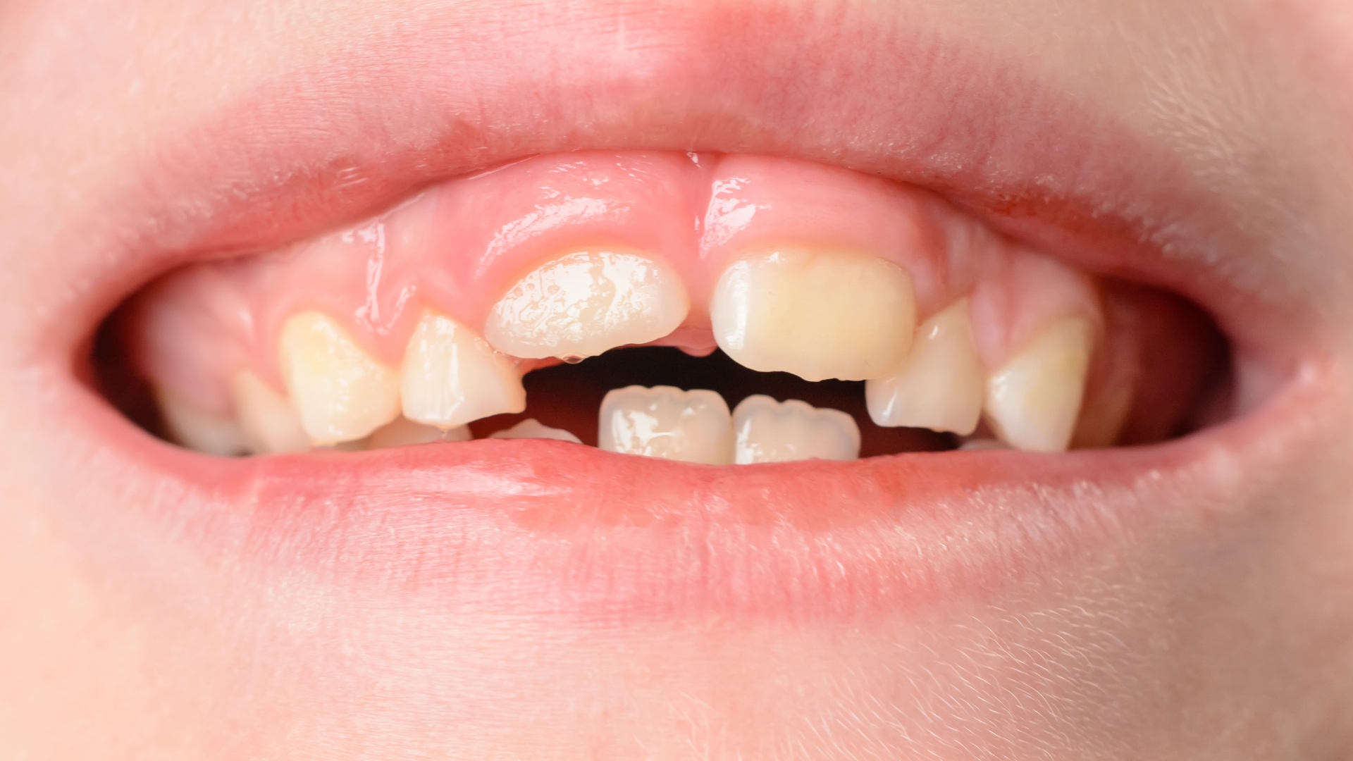 Lệch khớp cắn là gì? Nhận biết, điều chỉnh sớm để tránh lệch mặt - lệch hàm 2