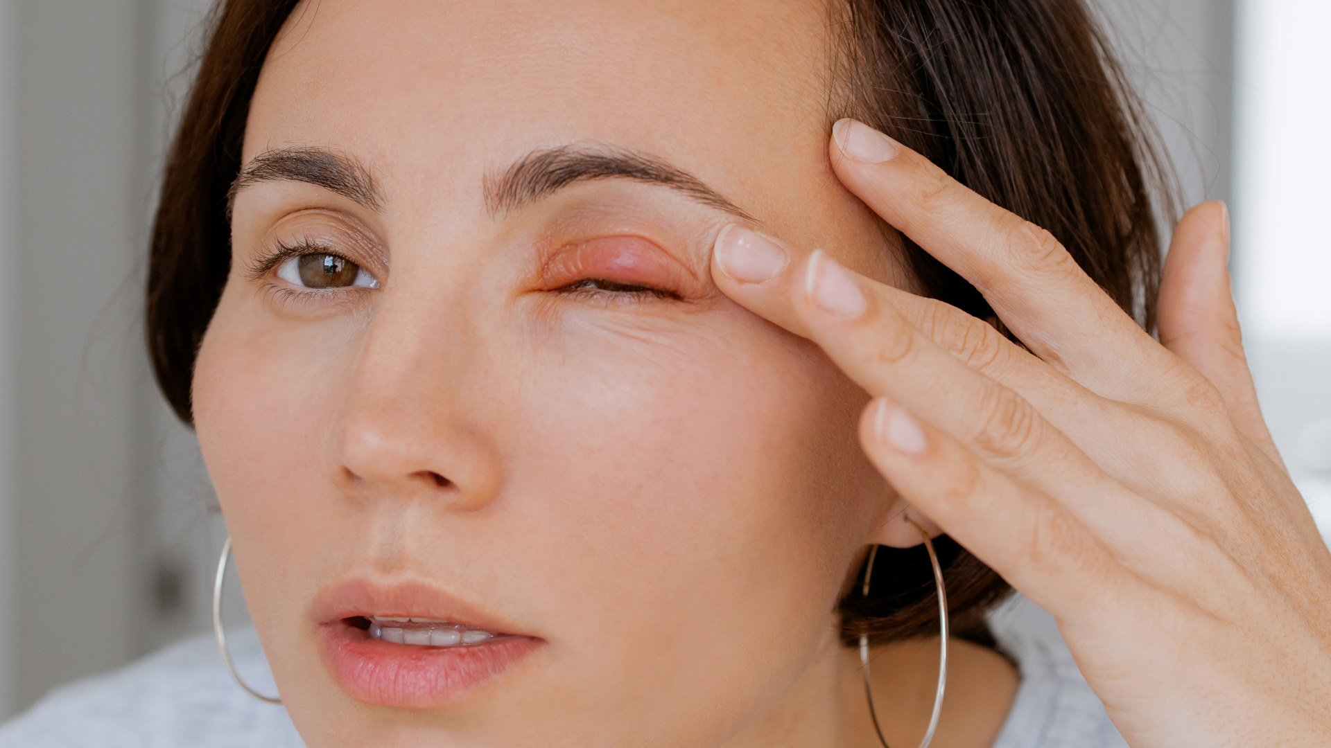 Lẹo mắt là gì? Nguyên nhân, triệu chứng và cách điều trị 5