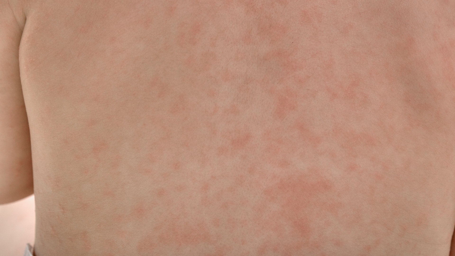 Sốt phát ban đỏ toàn thân, nóng rát da là một trong những triệu chứng toàn thân của nhóm vi khuẩn này