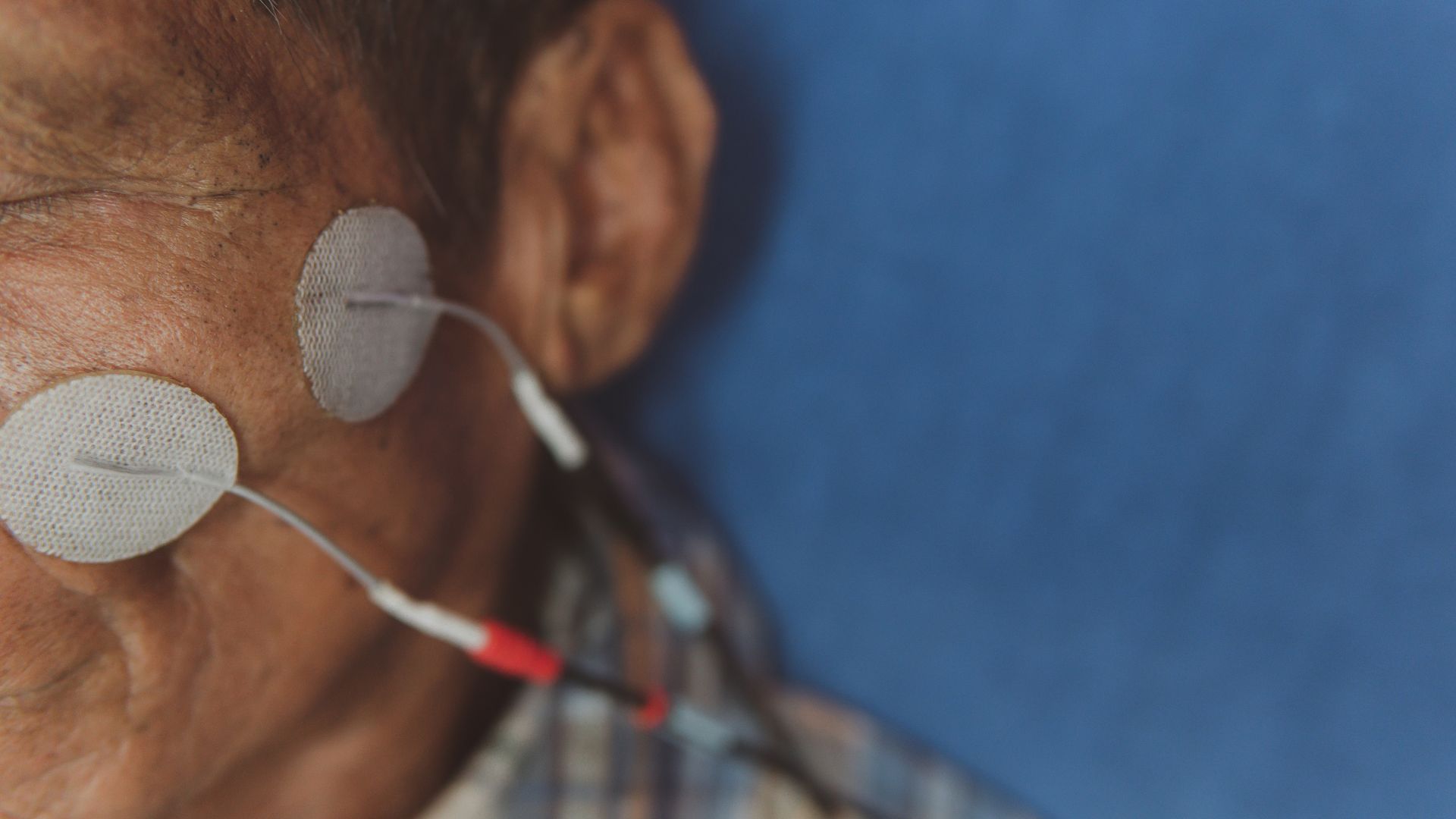 Có thể dùng điện châm để kích hoạt lưu thông máu khi dây thần kinh bị liệt