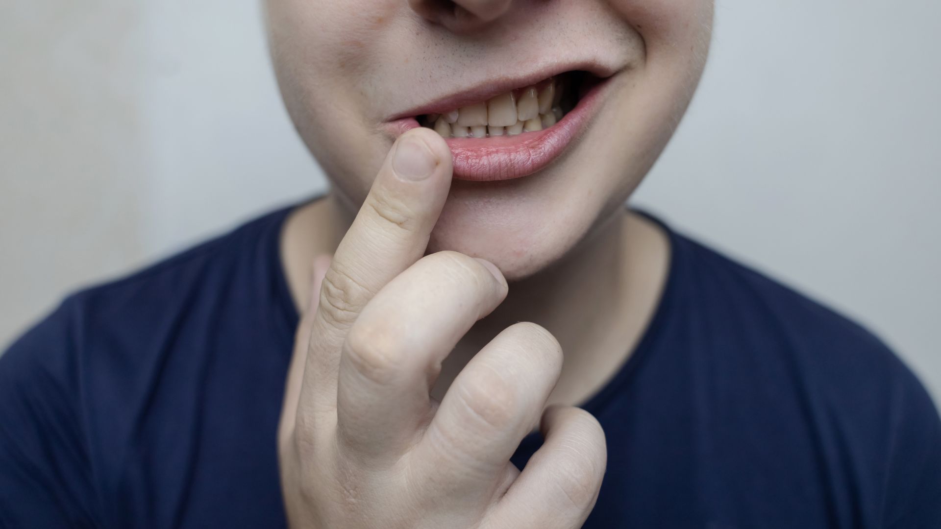 Liệt mặt ngoại biên xảy ra do các cơ vận động của một bên mặt bị liệt hoặc yếu