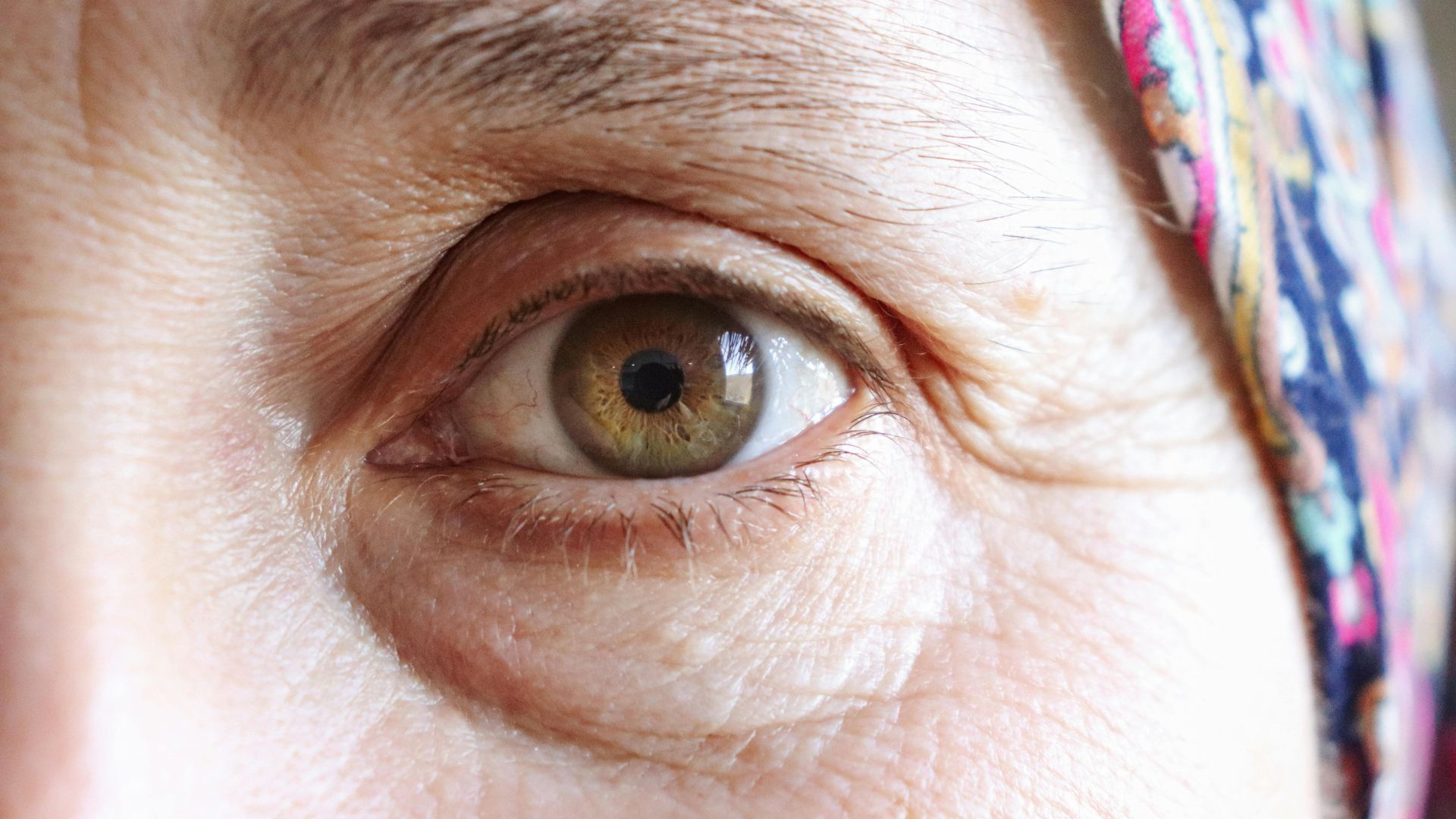 Chăm sóc mắt trong giai đoạn liệt mặt cấp là rất quan trọng