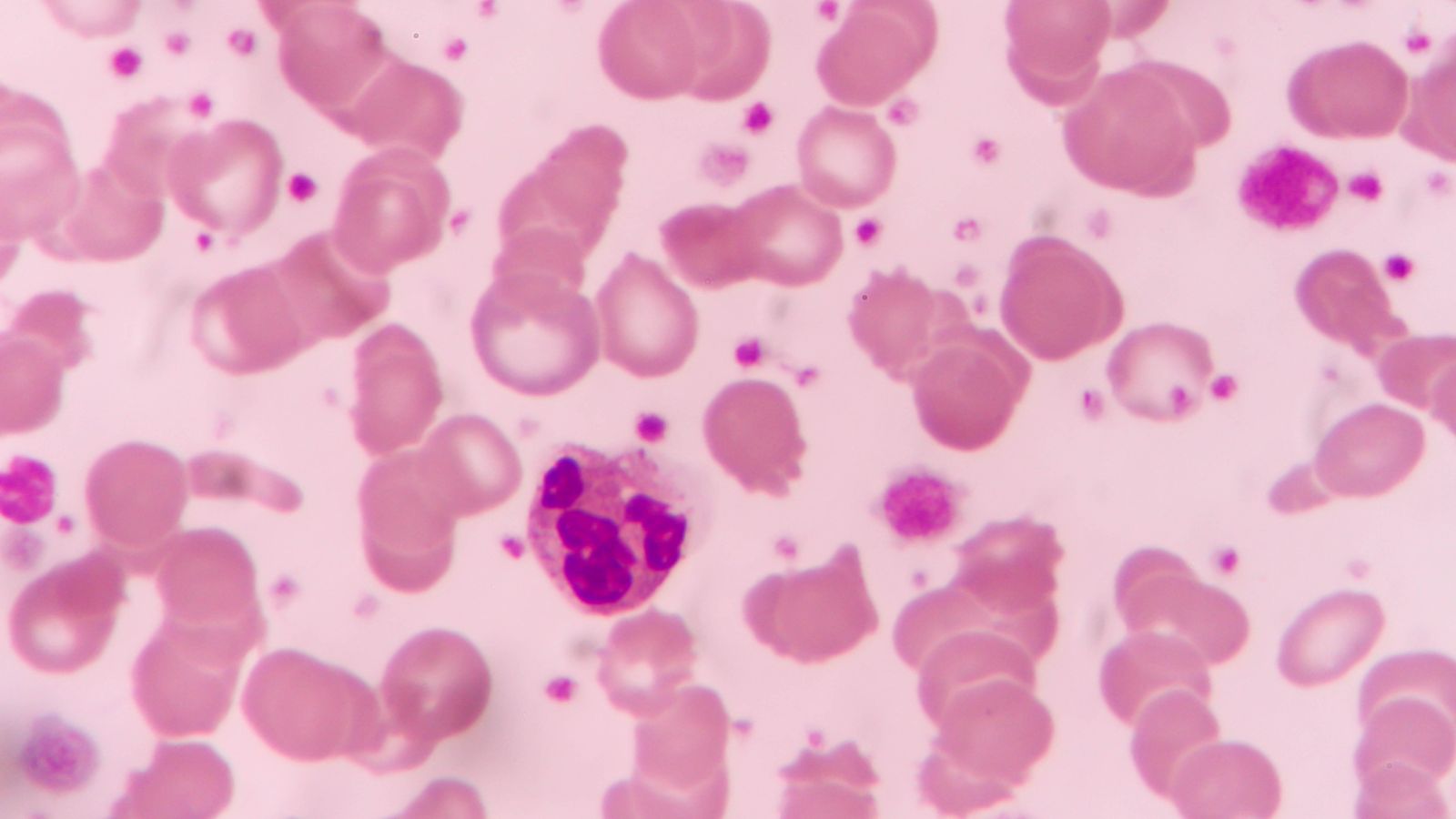 Có nhiều nguyên nhân gây nên bệnh tiểu cầu thấp