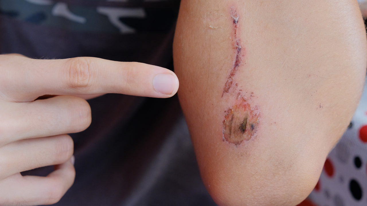 Vết thương đã lành có bị uốn ván không?