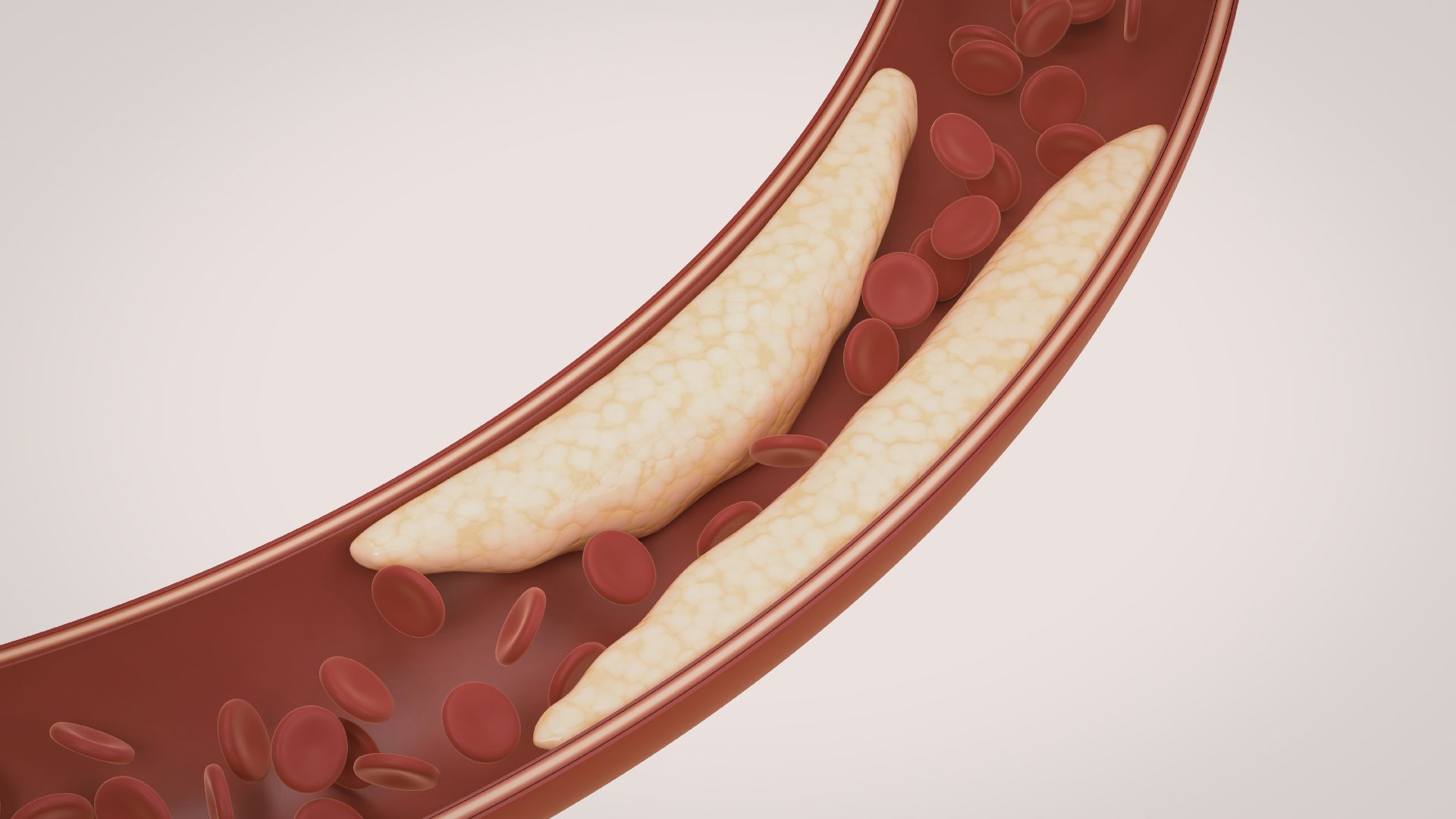 Nồng độ Lp(a) cao có liên quan đến các biến cố tim mạch nghiêm trọng như nhồi máu cơ tim