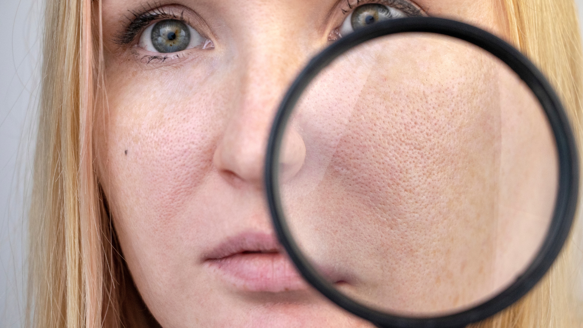 Lỗ chân lông to là vấn đề được nhiều người quan tâm và đây là một trong những tình trạng về da thường gặp