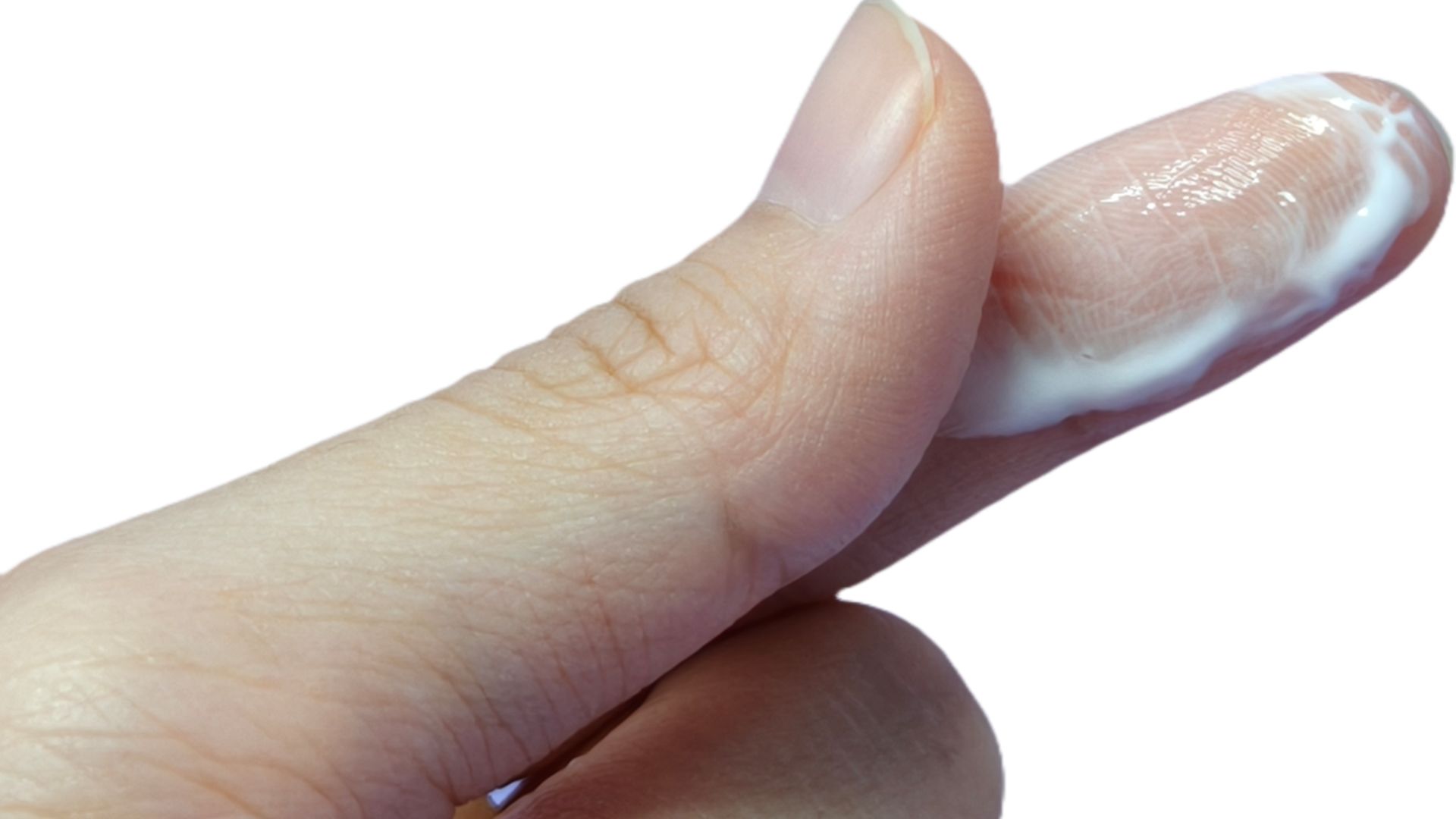 Triệu chứng thường gặp nhất của lộ tuyến cổ tử cung là tăng tiết dịch âm đạo