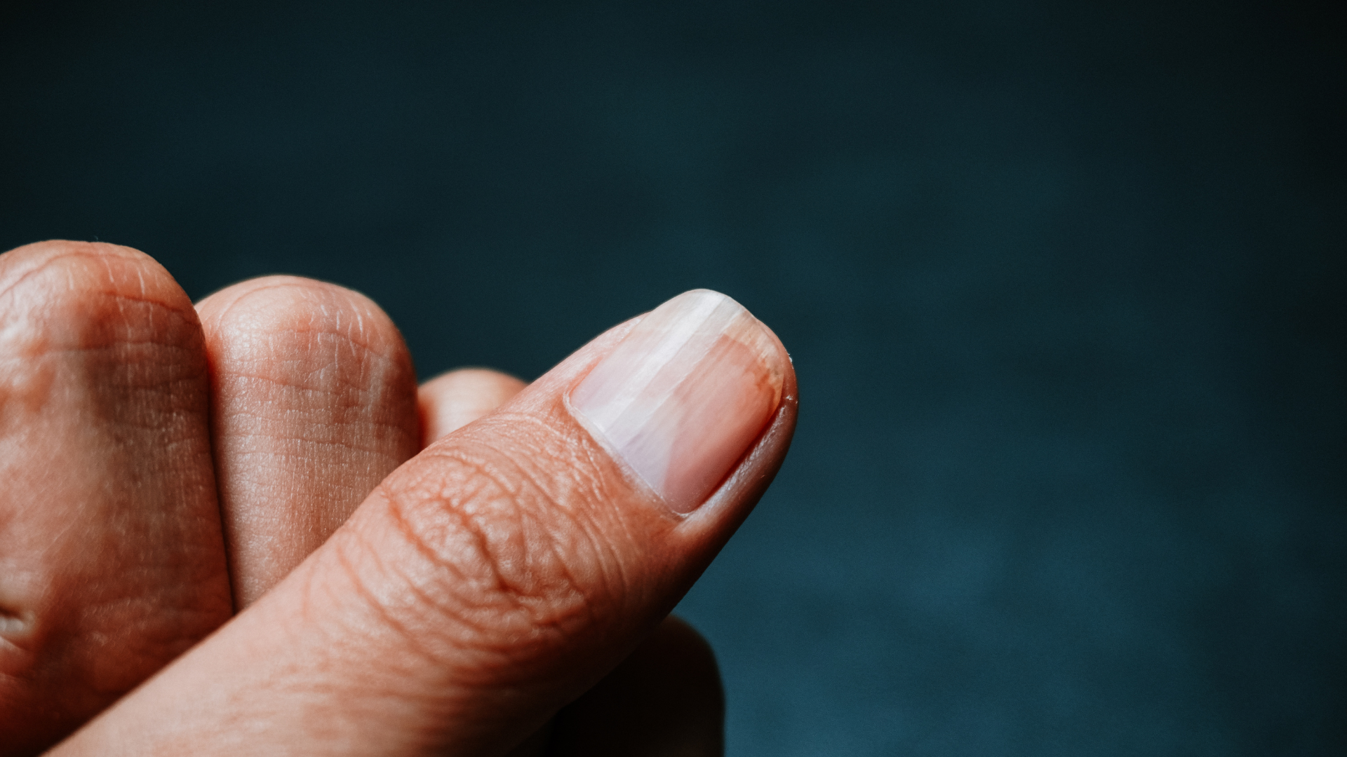 Nhận biết loạn dưỡng móng và tránh nhầm lẫn với bệnh lý khác