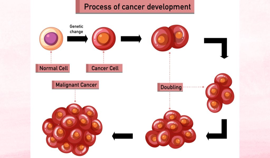 Loạn sản cổ tử cung có thể tiến triển thành ung thư nếu không theo dõi và điều trị kịp thời