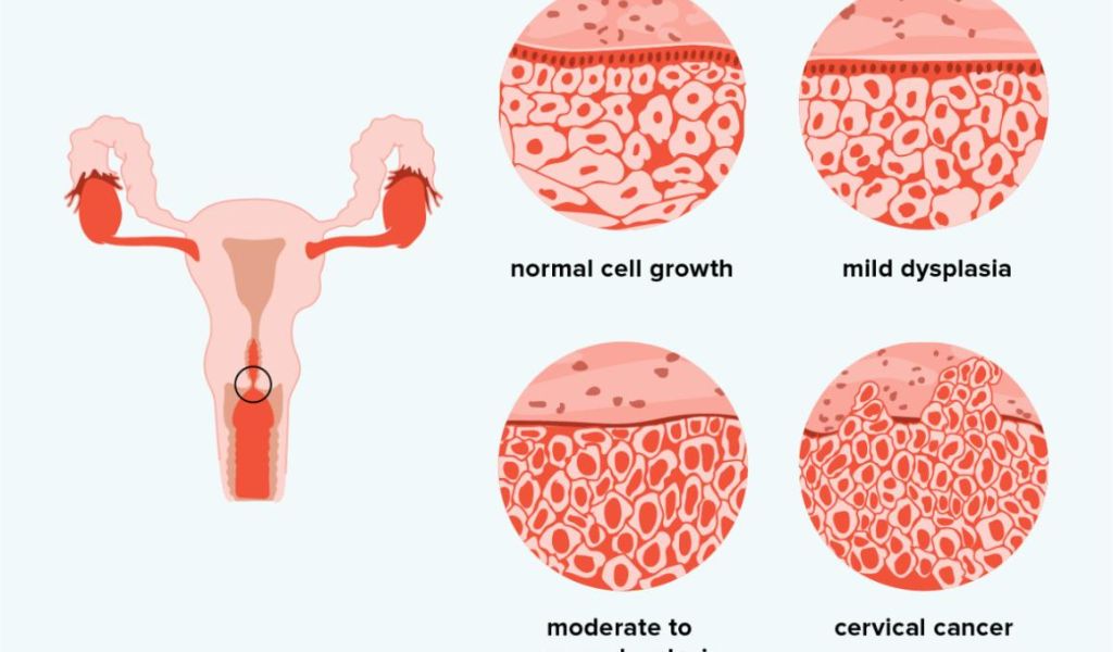 Hình ảnh mô phỏng tế bào bất thường ở cổ tử cung