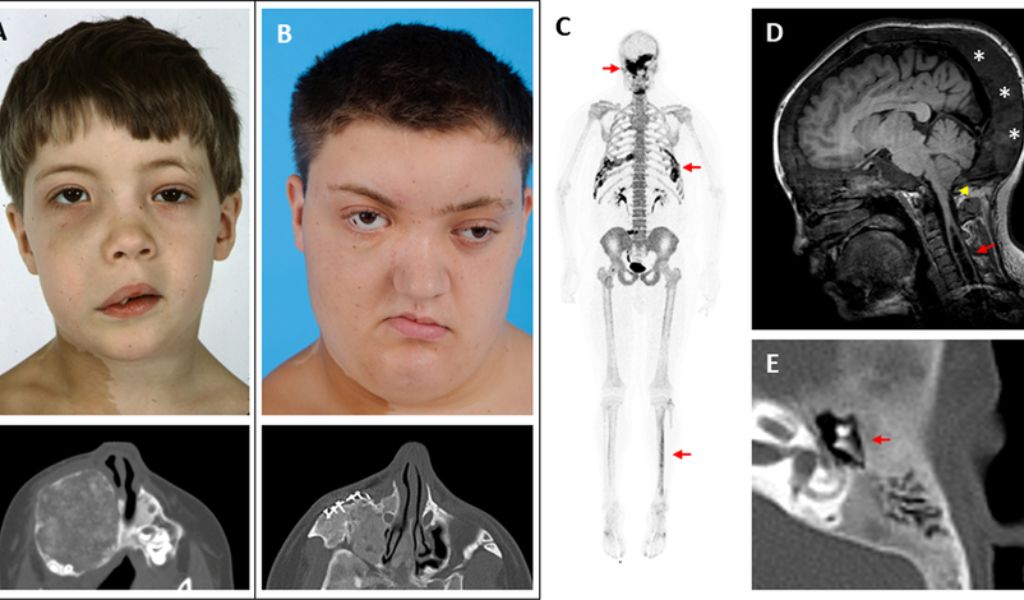 Hình ảnh X-quang loạn sản xơ sọ mặt
