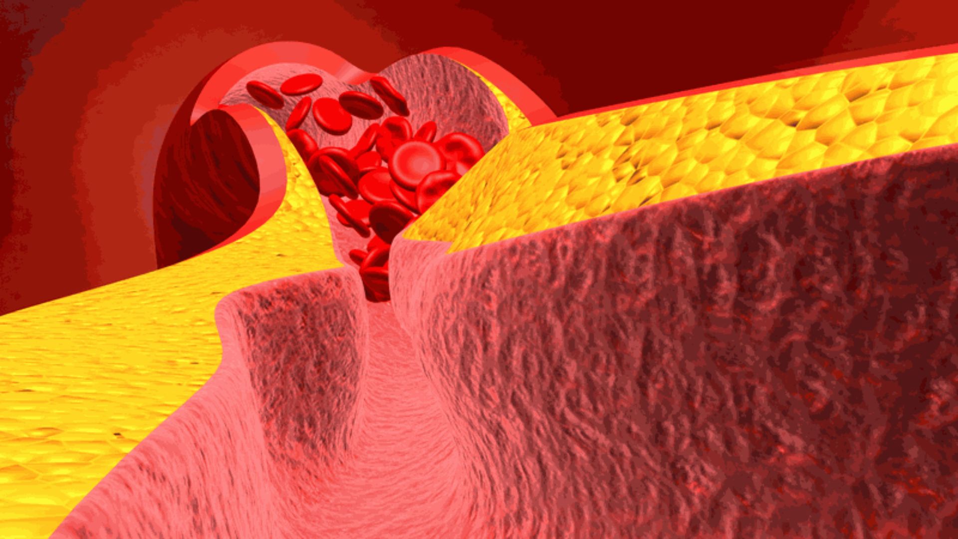 Lọc mỡ máu là phương pháp giúp loại bỏ mỡ xấu ra khỏi cơ thể ngay lập tức