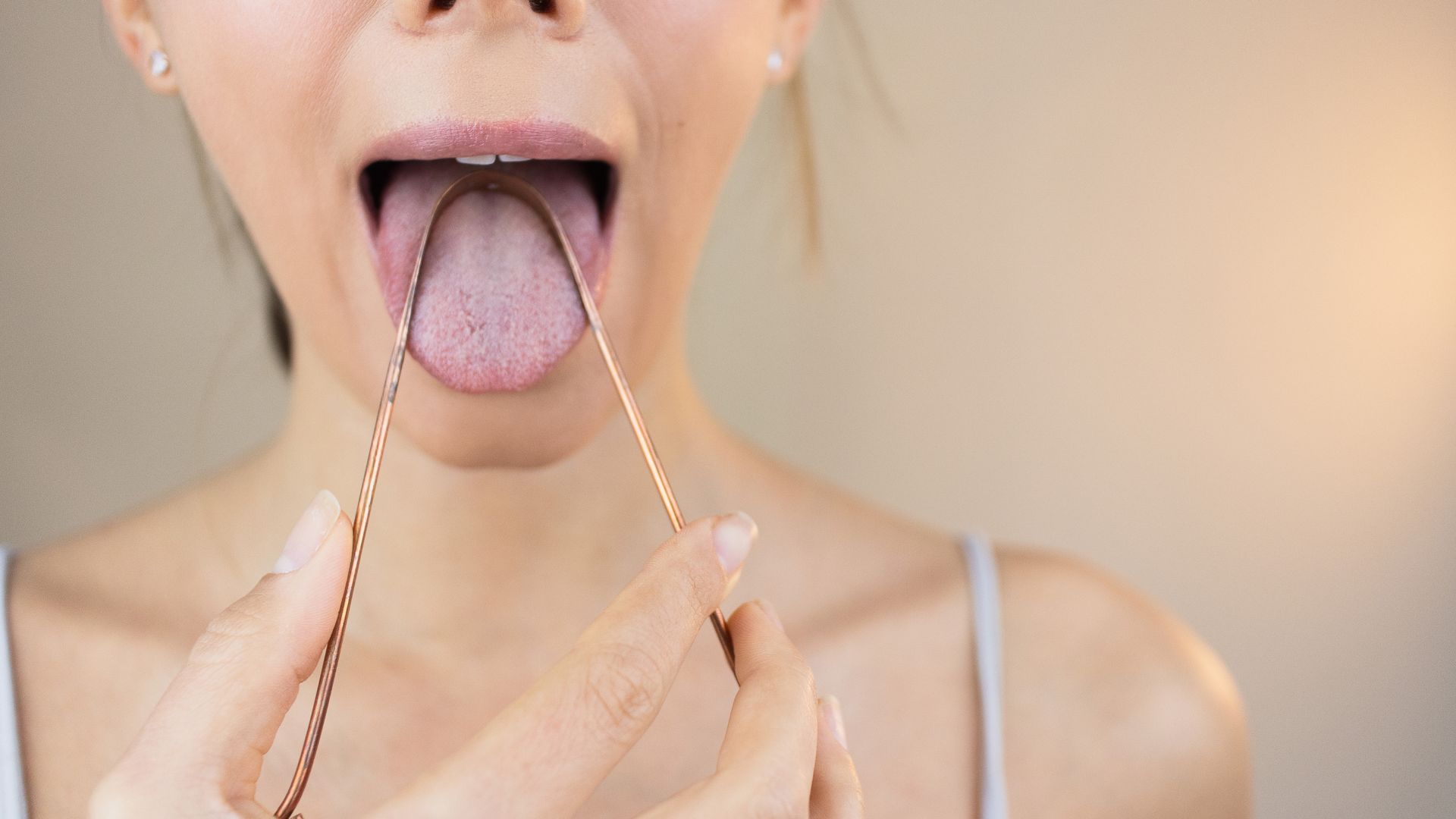 Lưỡi trắng hôi miệng thường liên quan đến sự tích tụ mảng bám và vi khuẩn trên bề mặt lưỡi