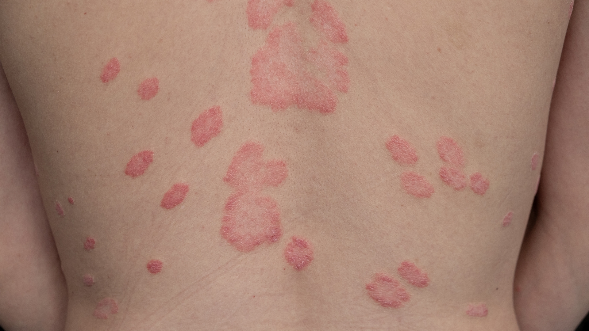 Lupus ban đỏ có ngứa không? Dấu hiệu và cách kiểm soát 2