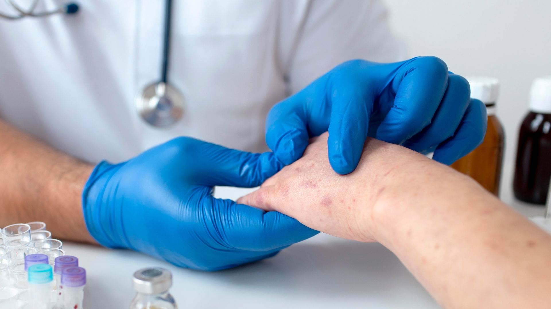 Lupus ban đỏ có ngứa không? Dấu hiệu và cách kiểm soát 5