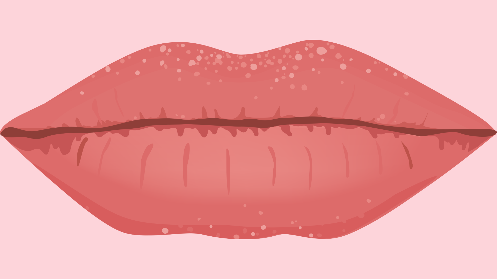 Hạt Fordyce có thể xuất hiện trên môi, niêm mạc miệng và cả vùng sinh dục