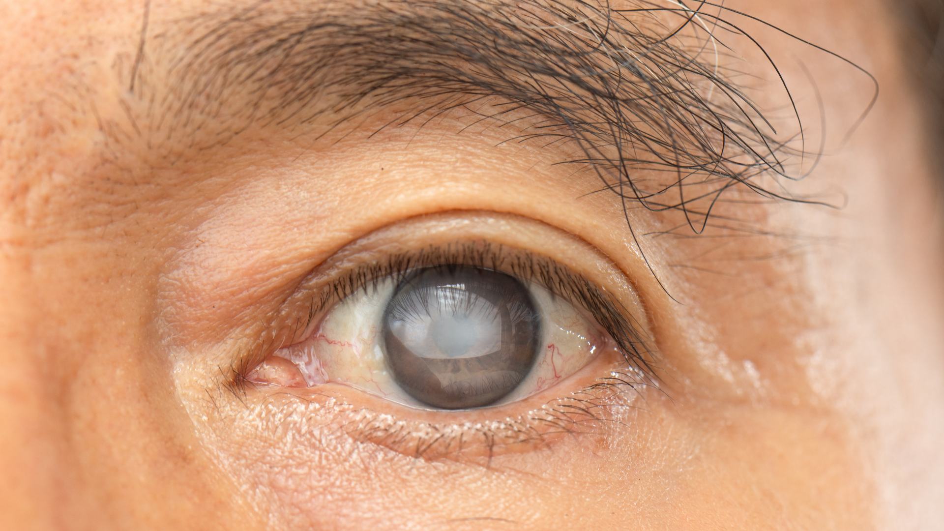 Mắt bị cườm nước có mổ được không?