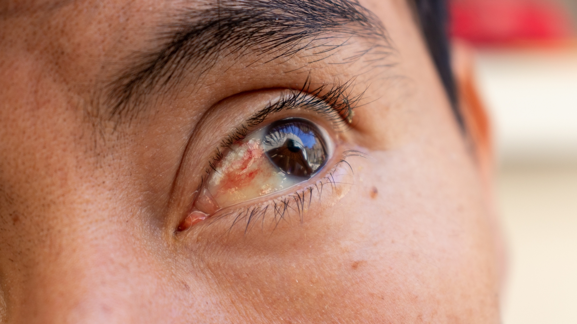 Xuất huyết dưới kết mạc thường khiến người bệnh hoảng sợ do vùng trắng mắt chuyển sang đỏ tươi hoặc đỏ bầm