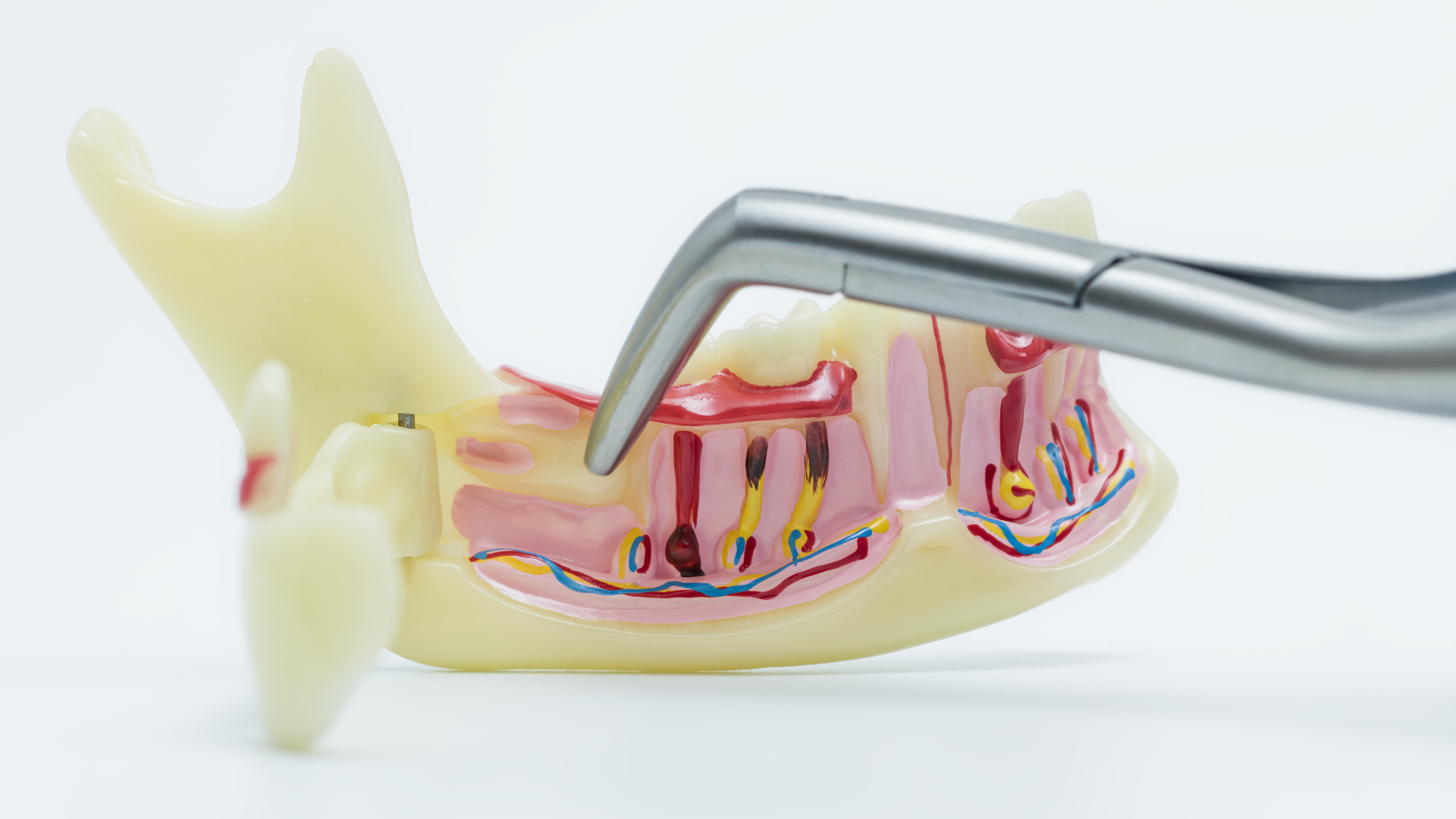 Mất răng số 7 lâu ngày có thể dẫn đến tình trạng tiêu xương hàm