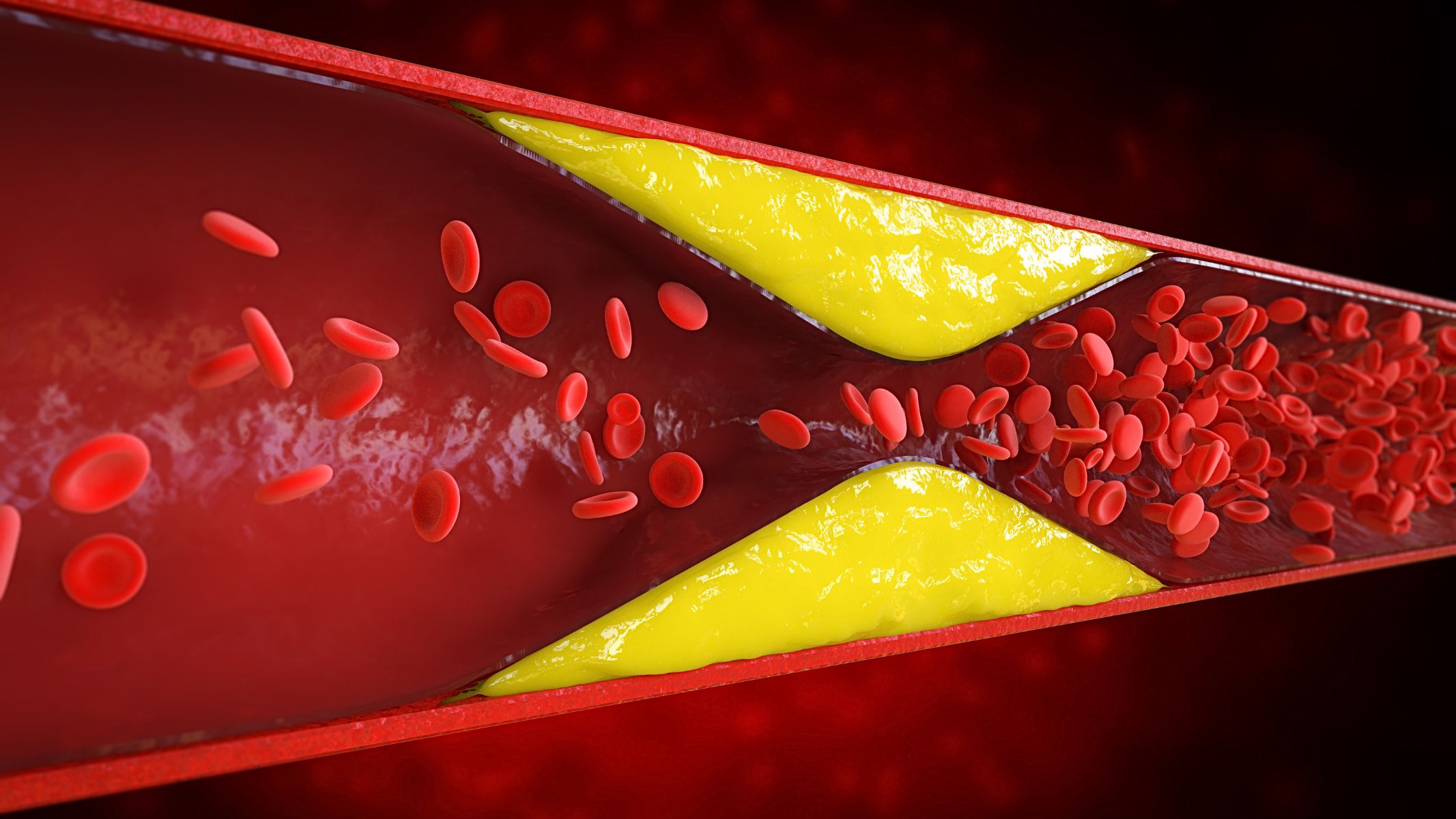 Máu nhiễm mỡ là tình trạng nồng độ cholesterol toàn phần, cholesterol xấu, triglycerid trong máu vượt quá ngưỡng bình thường