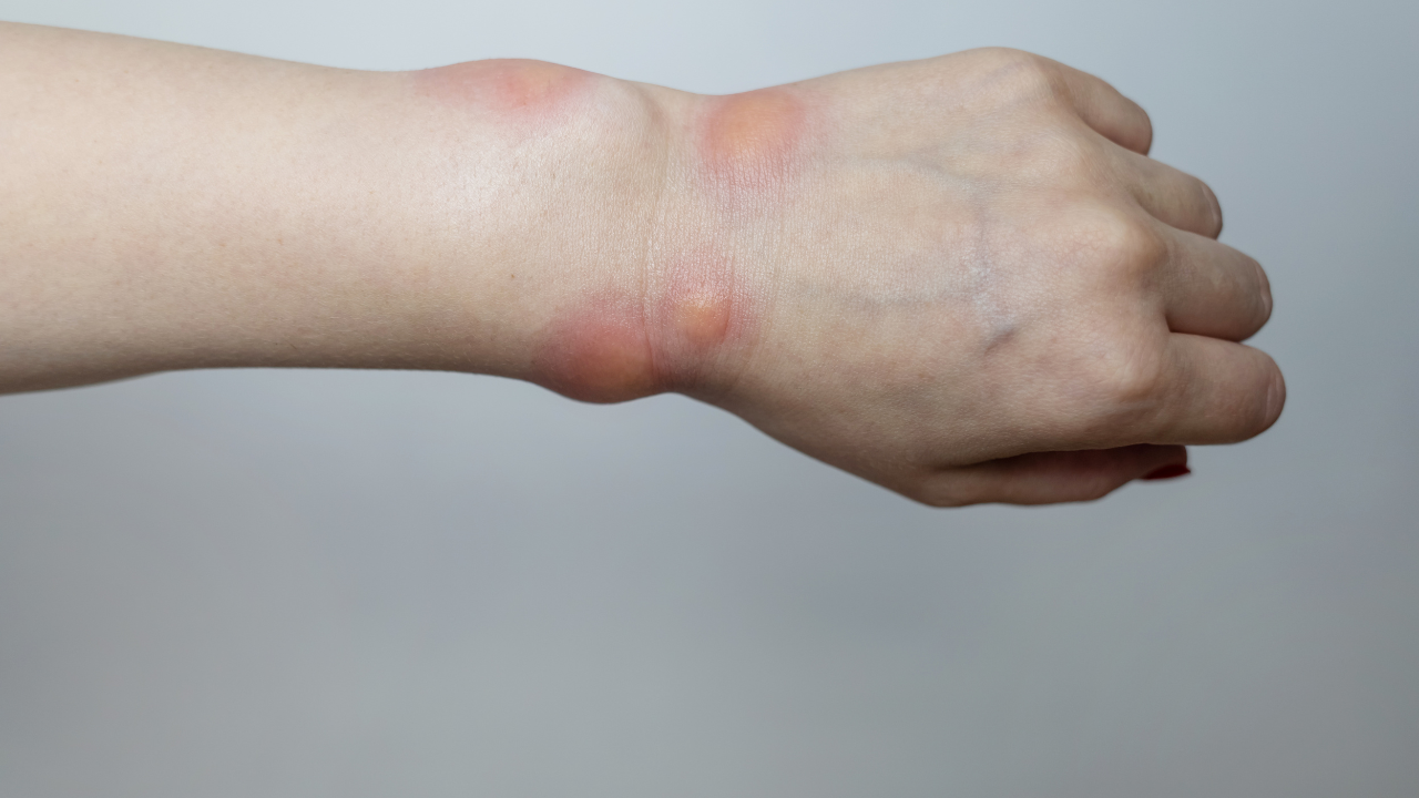 Mề đay phù mạch  ảnh hưởng lớp trung bì của da và gây ngứa rát, mẩn đỏ