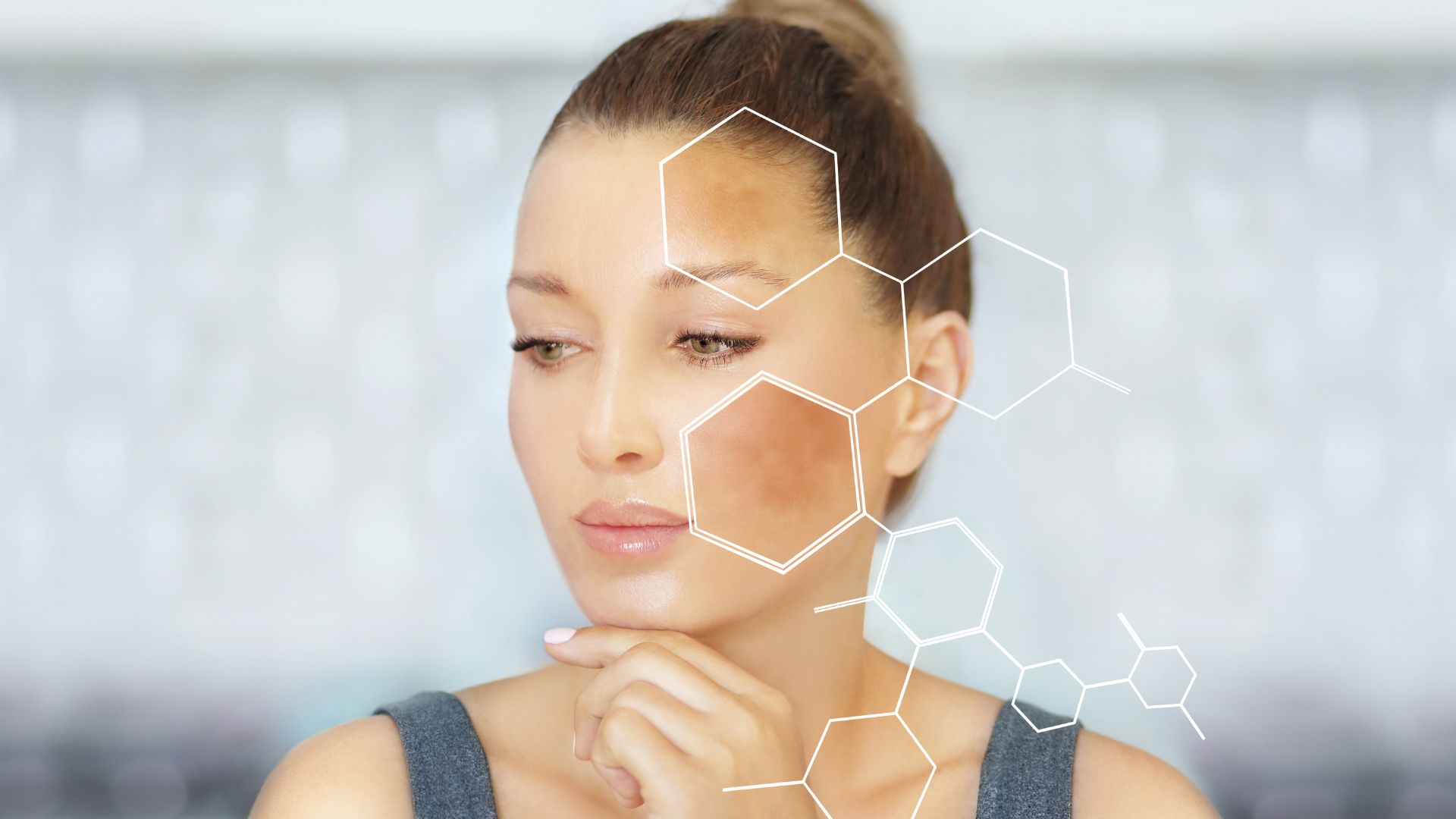 Nám da là một trong những bệnh do melanin gây ra
