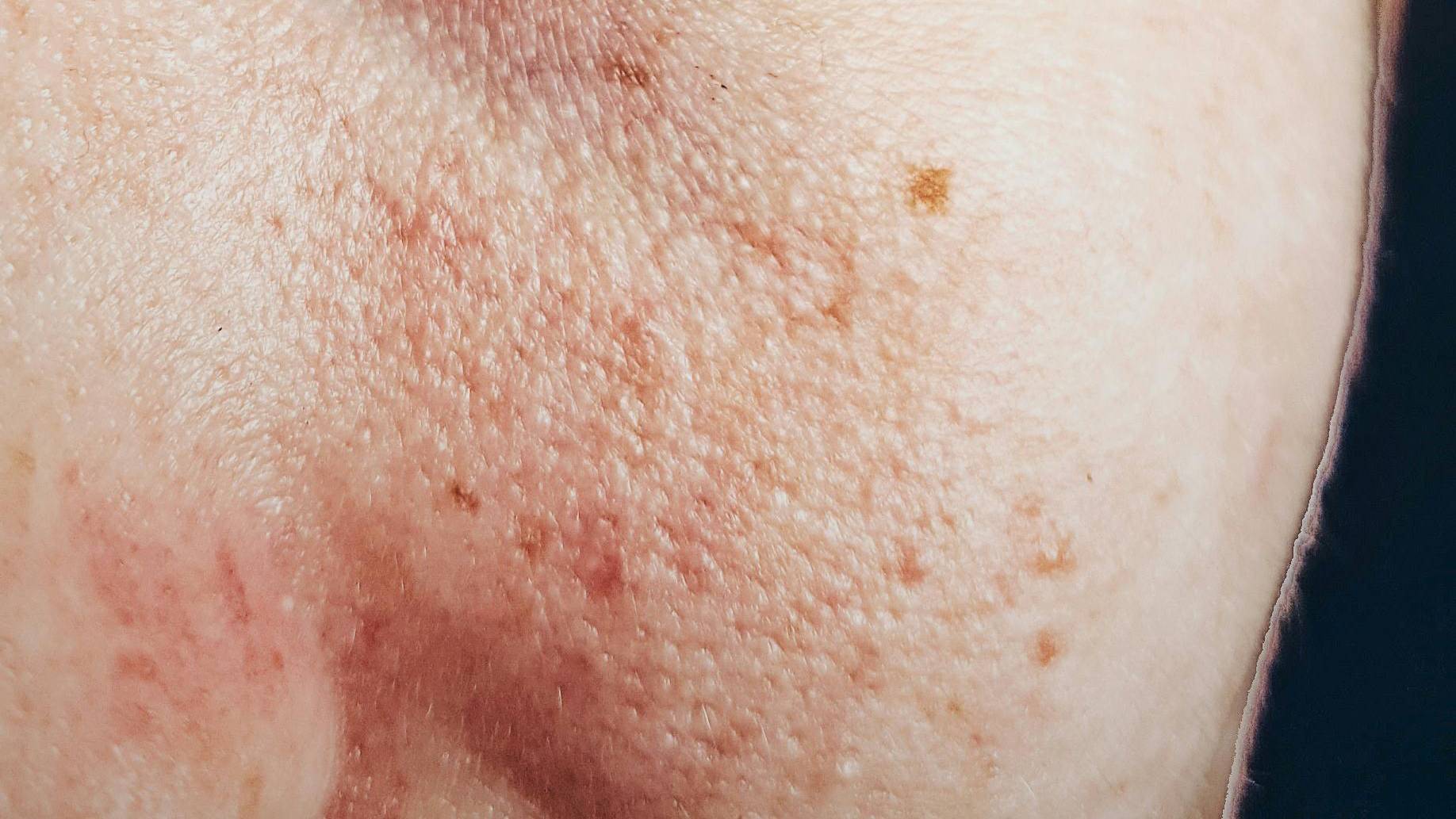 Cách phân biệt da khô da dầu là da khô có nếp nhăn li ti, xỉn màu và có xu hướng lão hóa sớm