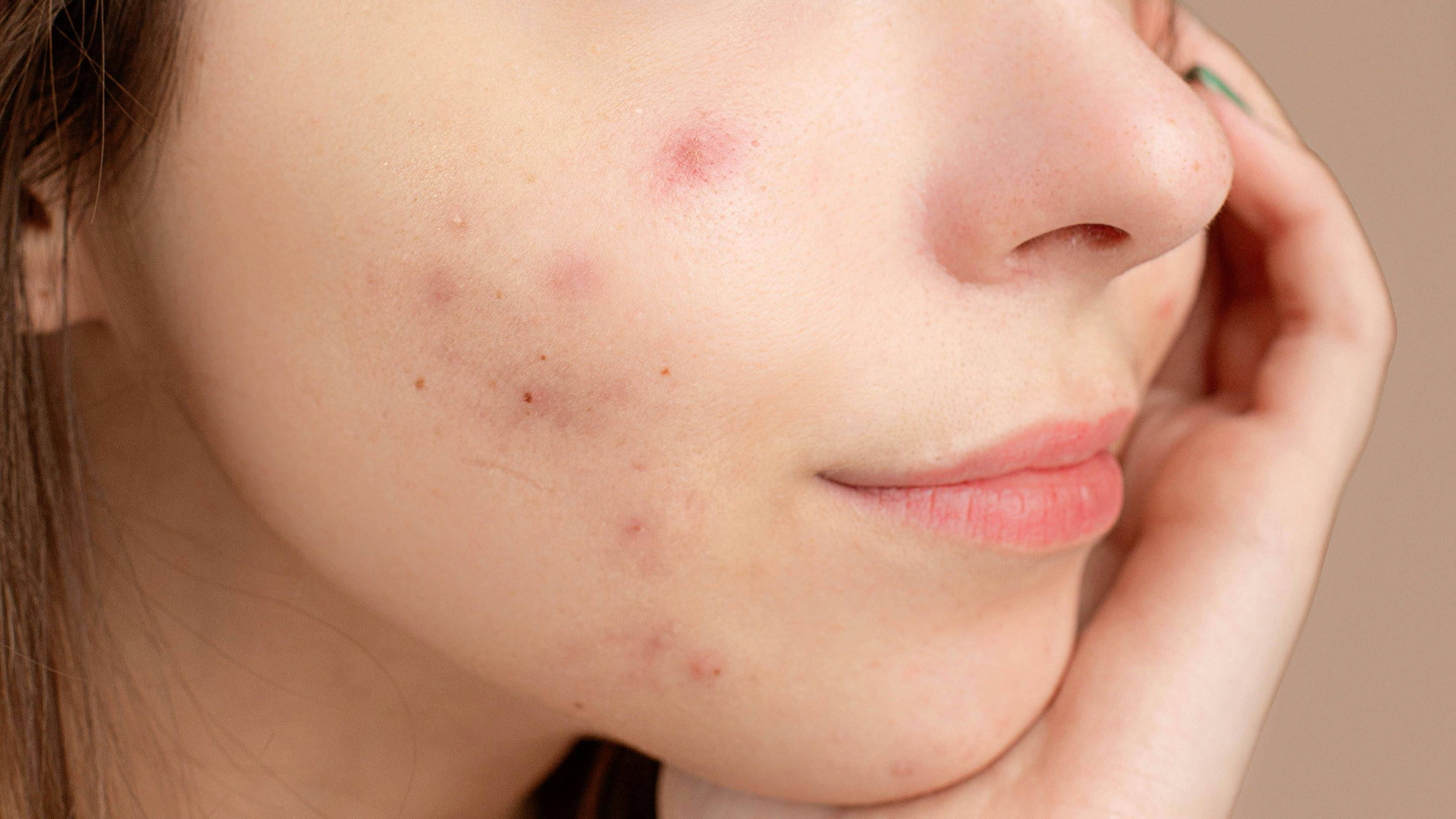 Da dầu dễ bị bít tắc lỗ chân lông, từ đó hình thành mụn đầu đen, mụn cám và mụn viêm