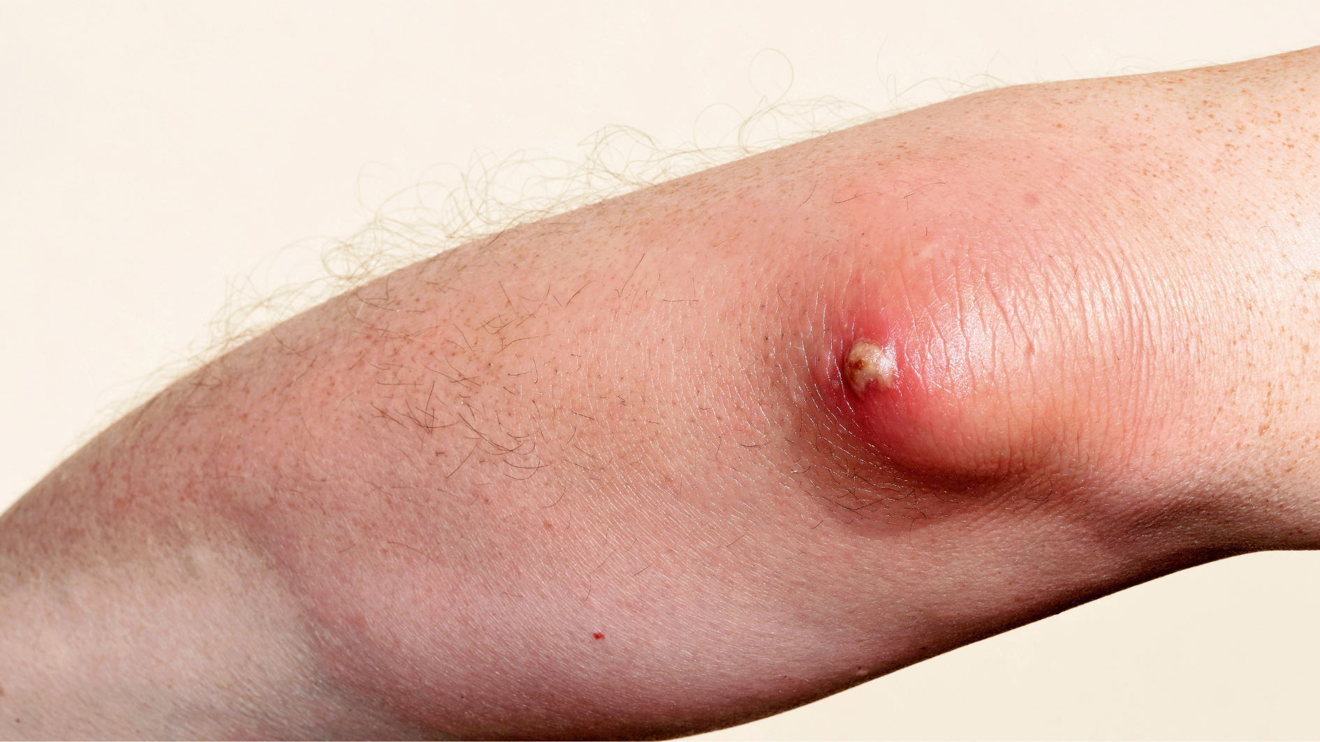 Mổ áp xe nhằm ngăn ngừa nhiễm trùng lây lan sang khu vực khác trong cơ thể