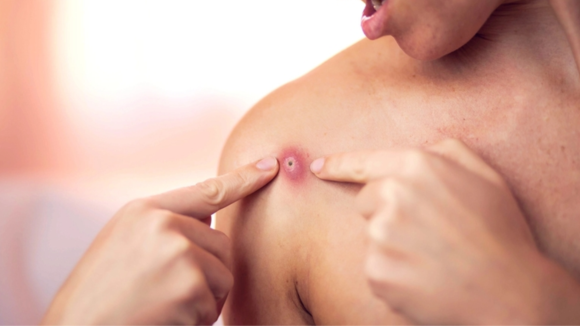 Áp xe nhỏ thường không gây nguy hiểm