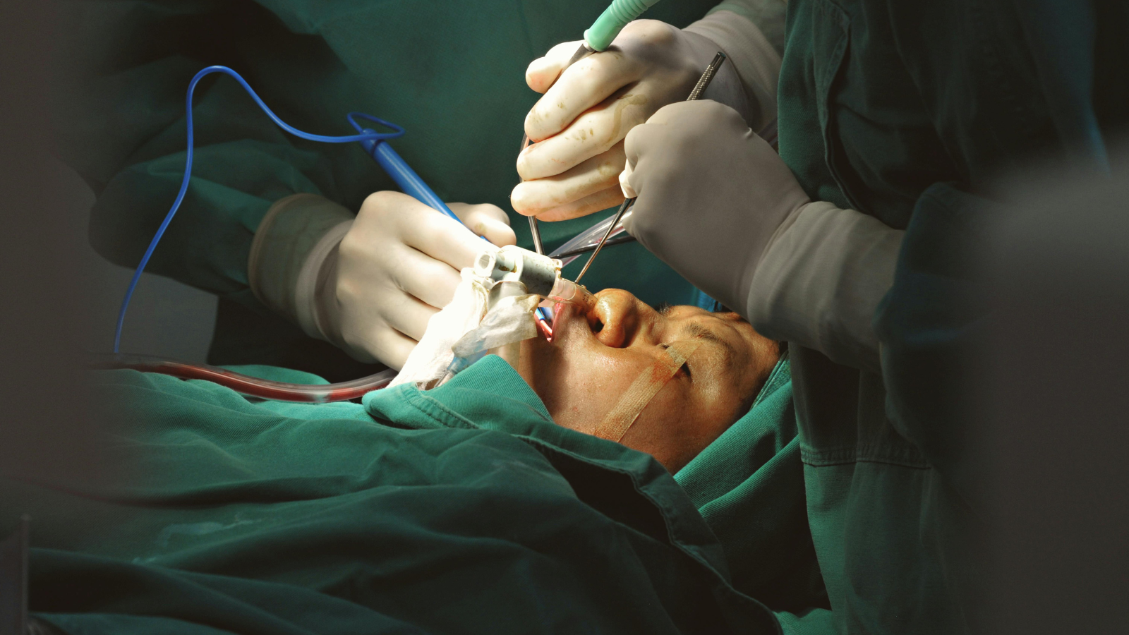 Phẫu thuật hạt xơ thanh quản được chỉ định khi triệu chứng bệnh trở nên nghiêm trọng