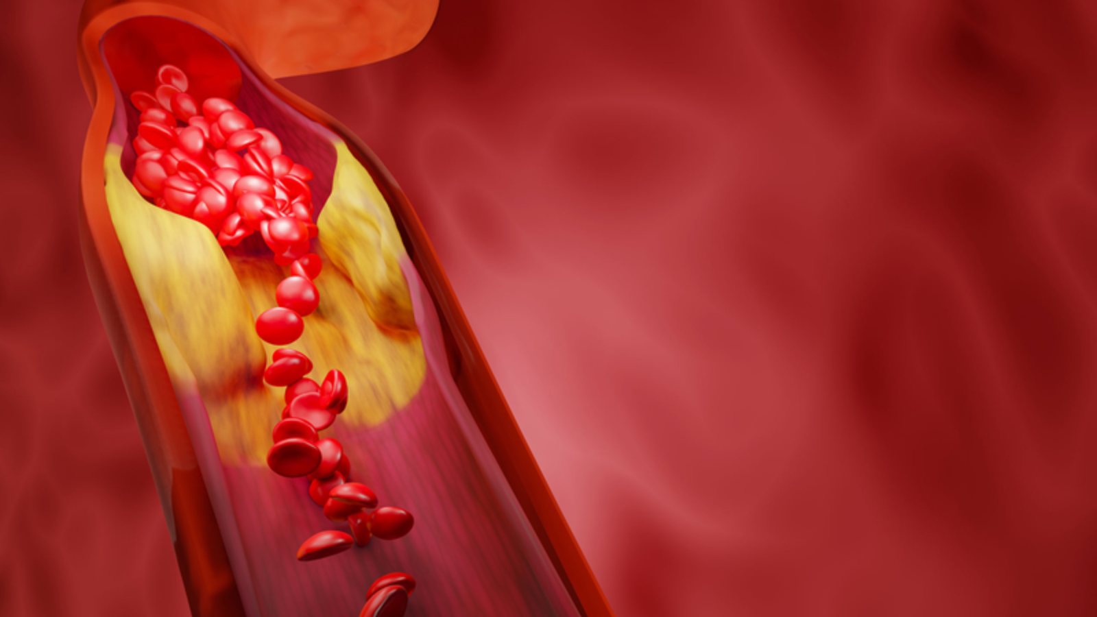 Mỡ máu cao là tình trạng tăng bất thường nồng độ lipid trong huyết tương