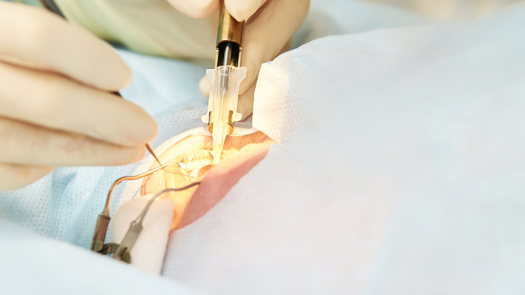 Mổ mộng mắt là một thủ thuật được tiến hành nhanh chóng, an toàn và thường không cần điều trị nội trú