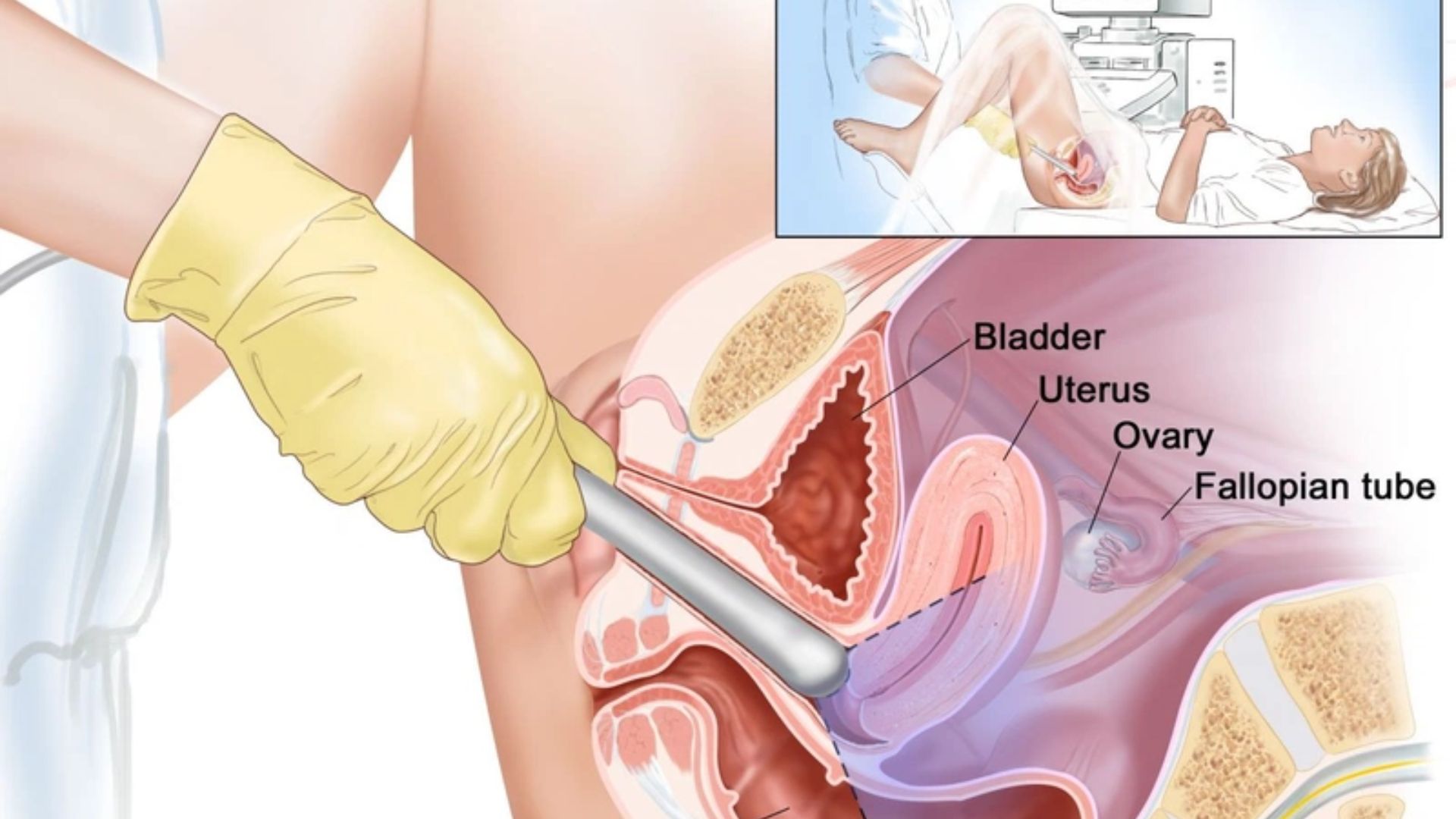 Mới có bầu có nên siêu âm đầu dò không? Giải đáp chính xác từ chuyên gia 2