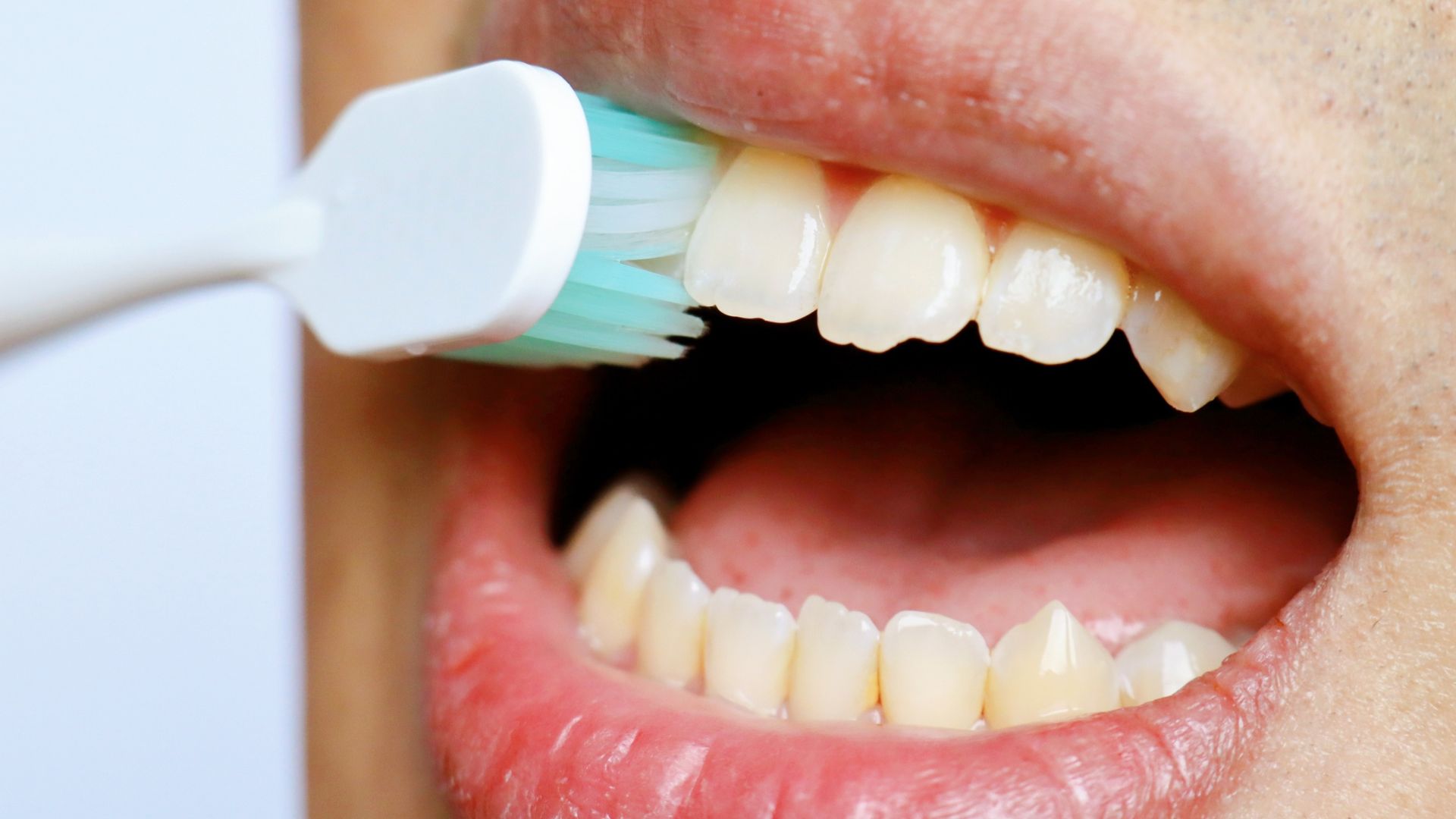 Mài mòn cơ học thường liên quan đến thói quen chải răng sai kỹ thuật như chải ngang hoặc lực mạnh