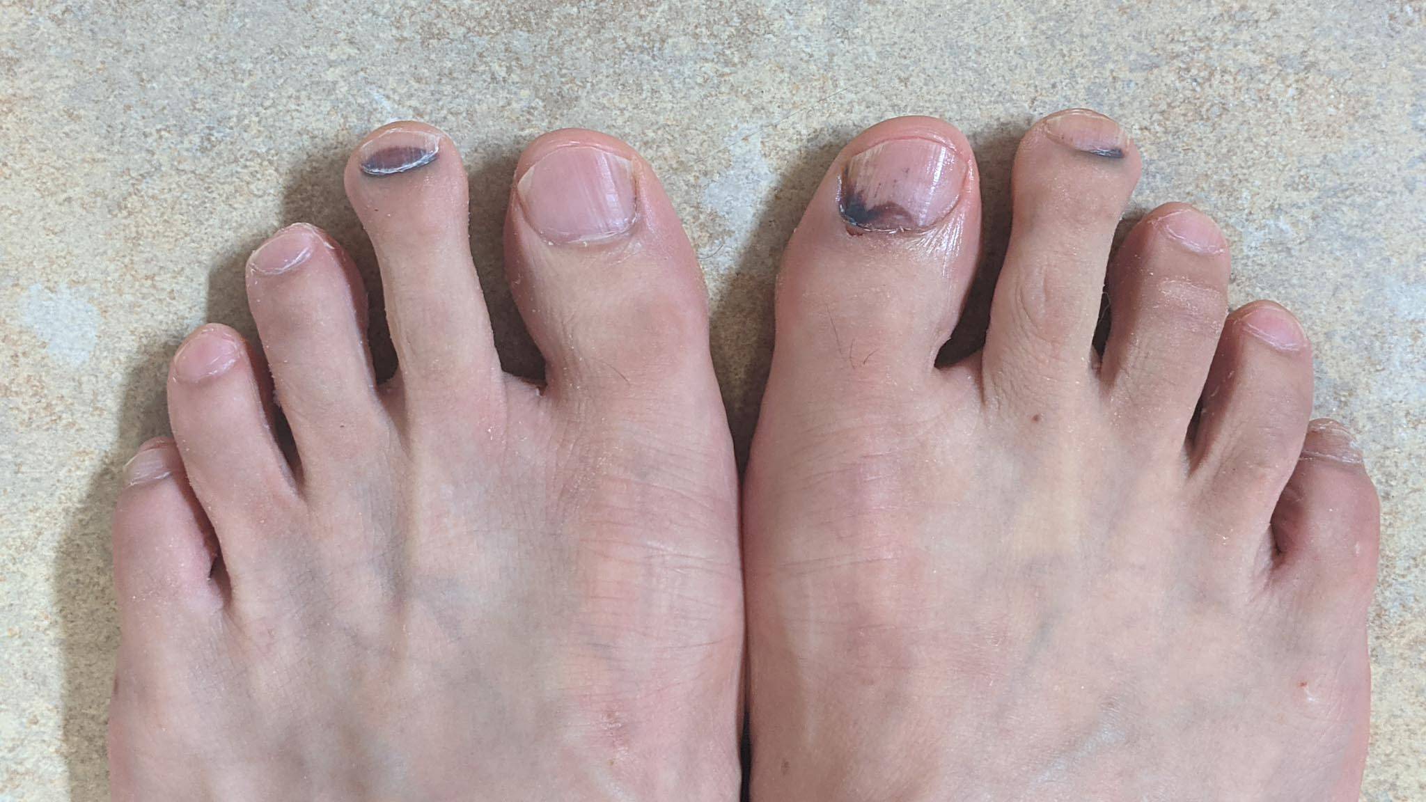 Móng chân bị đen có thể do bị chấn thương vùng ngón chân, kèm theo đau nhức