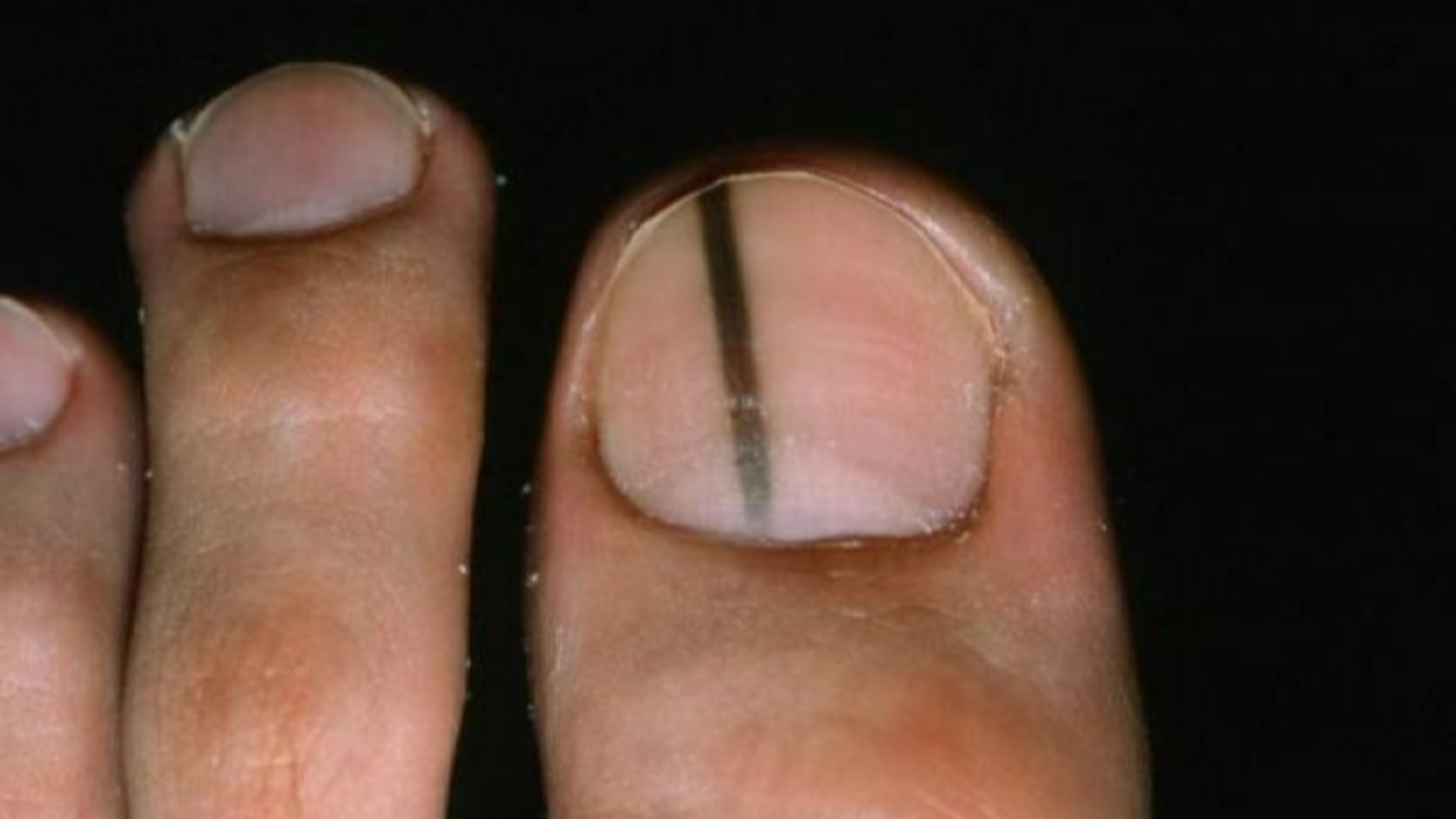 Móng chân có sọc đen là thay đổi màu sắc bất thường, có thể ở một hoặc nhiều ngón