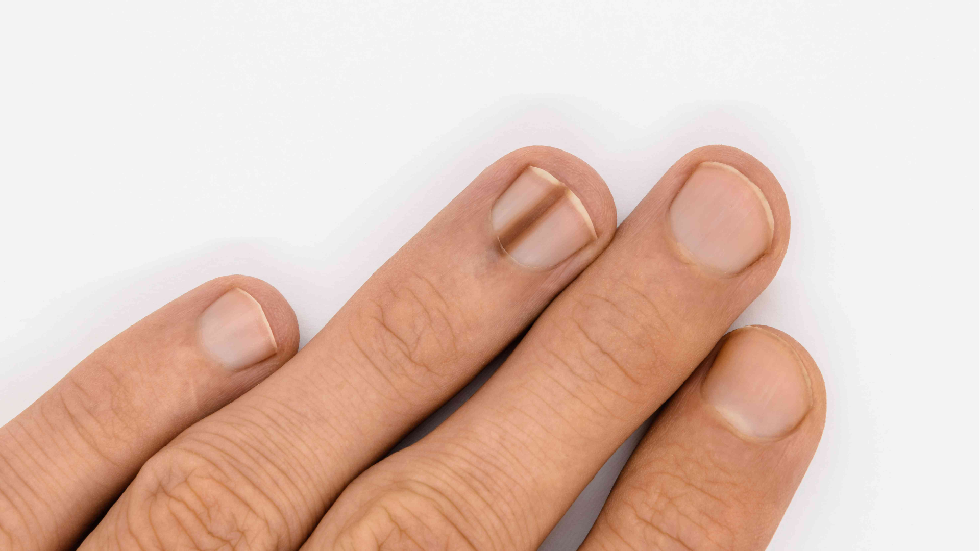 Móng tay bị sọc đen có thể chạy dọc hoặc ngang móng, độ đậm nhạt không đồng nhất